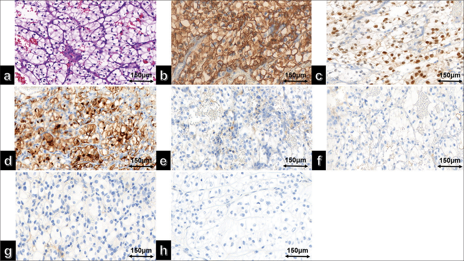 (a) High magnification of clear cell renal cell carcinoma hematoxylin and eosin; (b) immunohistochemical staining results showed positive expression of carbonic anhydrase IX, (c) Paired box gene 8 (PAX-8), (d) and cluster of differentiation 10 in the tumor cells. In contrast, (e) thyroid transcription factor-1, (f) Napsin A, (g) Cytokeratin 7 (CK7), and (h) Alpha-Methylacyl-CoA Racemase (P504S) were not expressed.