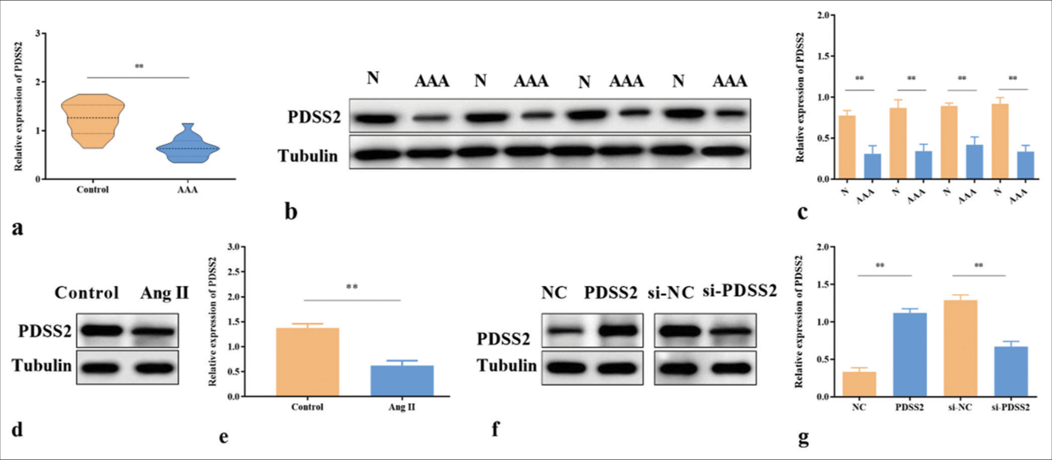 PDSS2 is downregulated in Ang II-treated VSMCs. (a) PDSS2 mRNA expression in AAA, n = 15. (b) PDSS2 protein expression in AAA, n = 4. (c) Statistical analysis of protein expressions. (d) PDSS2 protein expression in Ang II-treated VSMCs, n = 3. (e) Statistical analysis of protein expression. (f) PDSS2 expression in Ang II-treated VSMCs. (g) Statistical analysis of protein expression. ✶✶P < 0.01. PDSS2: Prenyl diphosphate synthase subunit 2, VSMCs: Vascular smooth muscle cells, Ang II: Angiotensin II, AAA: Abdominal aortic aneurysm, si-NC: Small interfering RNA negative control. N: Normal.