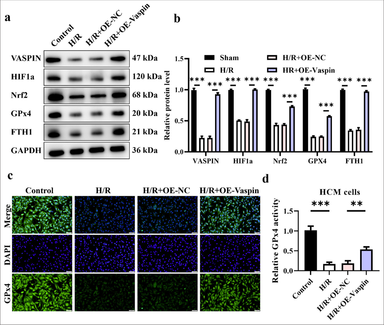 Vaspin regulates hypoxia/reoxygenation (H/R)-induced ferroptosis. (a and b) Vaspin and ferroptosis-related protein expression levels in transfected cells after H/R treatment. (c and d) Immunofluorescence staining for the ferroptosis marker glutathione peroxidase 4 in myocardial cells. Scale bar = 100 μm. The results were presented as mean ± standard deviation. n = 3; ✶✶P < 0.01, ✶✶✶P < 0.001.