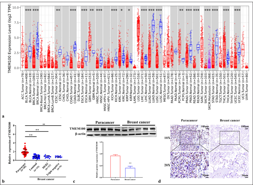 Downregulation of TMEM100 in breast cancer tissues. (a) TMEM100 expression in different cancers in the TIME2.0 database. (b) RTqPCR results showing the mRNA expression of TMEM100 in breast cancer tissues (n=40). (c) Western blot results showing the protein expression of TMEM100 in breast cancer tissues (n=40). (d) IHC staining of TMEM100 protein expression in breast cancer tissues and paracancer tissues (n=5, 10×: 100 μm; 20×: 50 μm). ✶ P < 0.05, ✶✶ P < 0.01, ✶✶✶ P < 0.001. TMEM100: Transmembrane protein 100, RT-qPCR: Real-time quantity polymerase chain reaction, IHC staining: Immunohistochemical staining. ACC: Adrenocortical carcinoma, BLCA: Bladder Urothelial Carcinoma, BRCA: Breast invasive carcinoma, CESC: Cervical squamous cell carcinoma and endocervical adenocarcinoma, CHOL: Cholangiocarcinoma, COAD: Colon adenocarcinoma, DLBC: Lymphoid Neoplasm Diffuse Large B-cell Lymphoma, ESCA: Esophageal carcinoma, GBM: Glioblastoma multiforme, HNSC: Head and Neck squamous cell carcinoma, HPV: Human Papillomavirus, KICH: Kidney Chromophobe, KIRC: Kidney renal clear cell carcinoma, LAML: Acute Myeloid Leukemia, LGG: Brain Lower Grade Glioma, LIHC: Liver hepatocellular carcinoma, LUAD: Lung adenocarcinoma, MESO: Mesothelioma, OV: Ovarian serous cystadenocarcinoma, PAAD: Pancreatic adenocarcinoma, PCPG: Pheochromocytoma and Paraganglioma, PRAD: Prostate adenocarcinoma, READ: Rectum adenocarcinoma, SARC: Sarcoma, SKCM: Skin cutaneous melanoma, STAD: Stomach adenocarcinoma, TGCT: Testicular germ cell tumors, THCA: Thyroid carcinoma, THYM: Thymoma, UCEC: Uterine corpus endometrial carcinoma, UCS: Uterine, UVM: Uveal melanoma, HER2: human epidermal growth factor receptor-2.