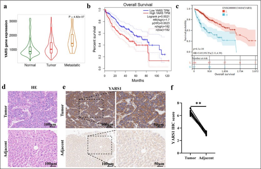 Tyrosyl-tRNA synthetase 1 (YARS1) is overexpressed in hepatocellular carcinoma (HCC). (a) YARS1 expression in HCC tumors. (b and c) The relevance of YARS1 levels and overall survival curves in HCC. (d) Representative photographs of YARS1 hematoxylin–eosin assays in HCC tumors. (e) Representative photographs of YARS1 immunohistochemistry (IHC) assays in HCC tumors. (f) Statistical quantification of IHC score. ✶✶✶ P < 0.001.