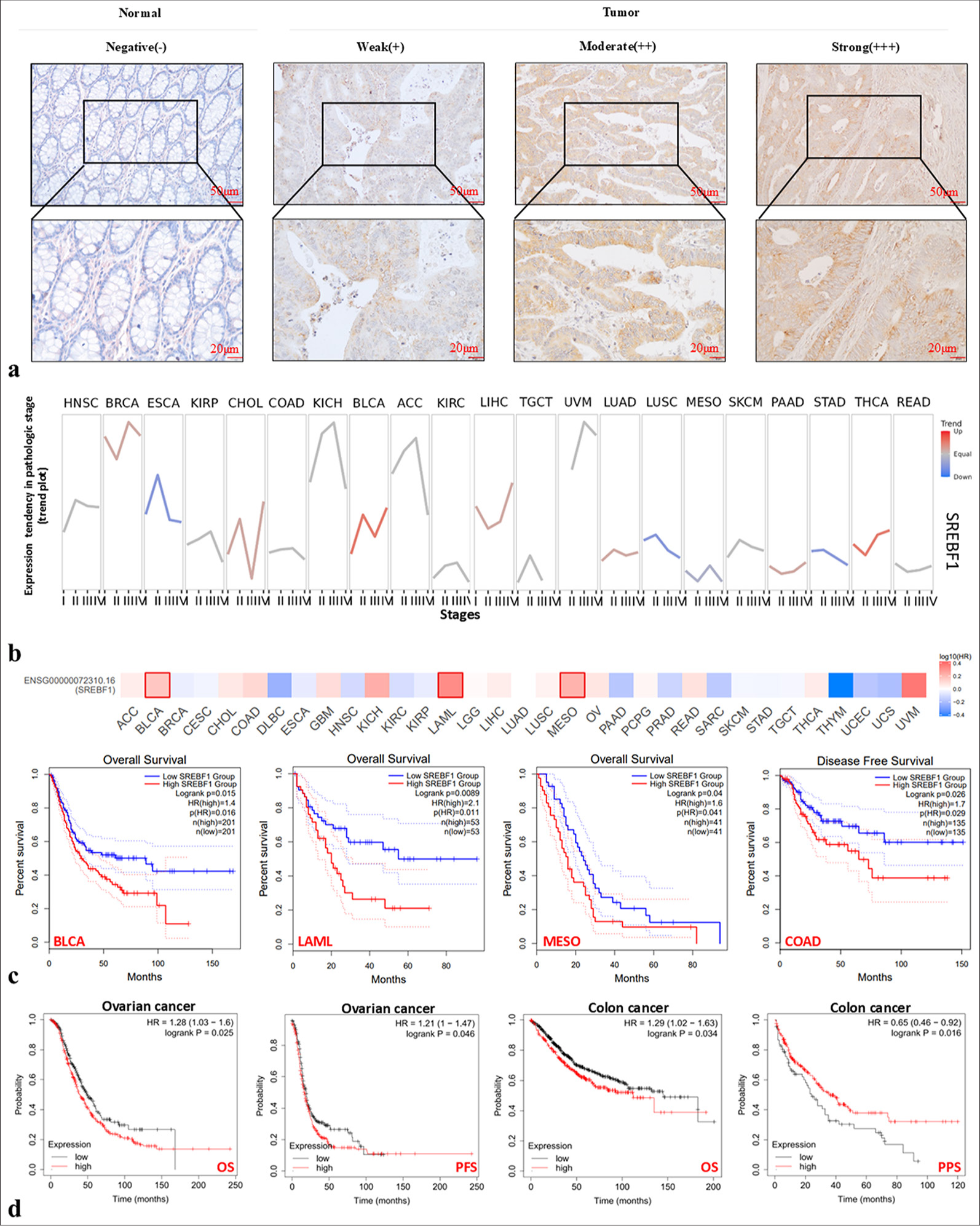 The high expression of Sterol Regulatory Element Binding Transcription Factor 1 (SREBF1) is closely related to the clinical staging of patients and their prognosis. (a) Immunohistochemical staining showed that SREBF1 was greatly overexpressed in colon adenocarcinoma tissues compared to normal tissues. (b) The correlation between SREBF1 expression level and clinical stage in pan-cancer patients via Gene Set Cancer Analysis database. (c and d) Detect the prognostic correlation between SREBF1 expression level and patient survival through the Gene Expression Profiling Interactive Analysis database. ACC: Adrenocortical carcinoma, BLCA: Bladder urothelial carcinoma, BRCA: Breast invasive carcinoma, CESC: Cervical squamous cell carcinoma and endocervical adenocarcinoma, CHOL: Cholangiocarcinoma, COAD: Colon adenocarcinoma, DLBC: Lymphoid neoplasm diffuse large B-cell lymphoma, ESCA: Esophageal carcinoma, GBM: Glioblastoma multiforme, HNSC: Head and neck squamous cell carcinoma, HPV: Human Papillomavirus, KICH: Kidney chromophobe, KIRC: Kidney renal clear cell carcinoma, KIRP: Kidney renal papillary cell carcinoma, LAML: Acute Myeloid Leukemia, LGG: Brain Lower Grade Glioma, LIHC: Liver hepatocellular carcinoma, LUAD: Lung adenocarcinoma, LUSC: Lung squamous cell carcinoma, MESO: Mesothelioma, OV: Ovarian serous cystadenocarcinoma, PAAD: Pancreatic adenocarcinoma, PCPG: Pheochromocytoma and Paraganglioma, PRAD: Prostate adenocarcinoma, READ: Rectum adenocarcinoma, SARC: Sarcoma, SKCM: Skin Cutaneous Melanoma, STAD: Stomach adenocarcinoma, TGCT: Testicular Germ Cell Tumors, THCA: Thyroid cancer, THYM: Thymoma, UCEC: Uterine corpus endometrial carcinoma, UCS: Uterine Carcinosarcoma, UVM: Uveal Melanoma.