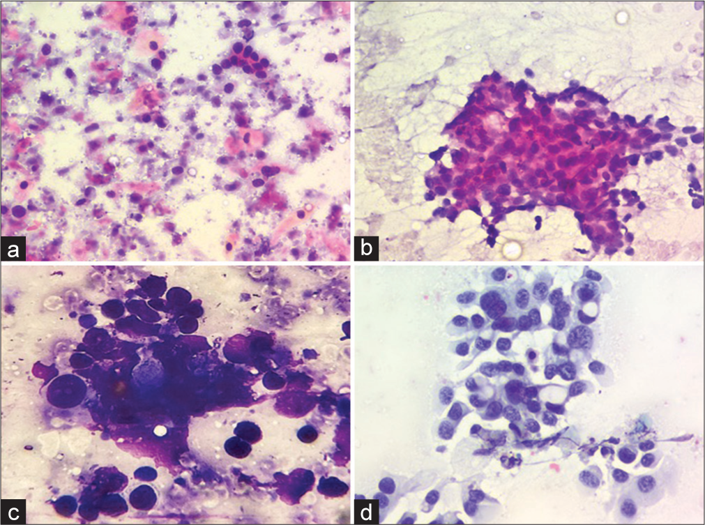 Cytological features of malignant cases on liquid-based cytology (LBC) and conventional smears (a) A case of squamous cell carcinoma exhibiting atypical cells scattered against a background with tumor diathesis on conventional Giemsa stained smears (200×) (b) The same case exhibiting monolayered sheet of tumor cells with better nuclear details against a clear background on LBC Papanicolaou stain (200×) (c) A case of metastatic adenocarcinoma exhibiting a cluster of atypical cells with nuclear overlapping and overcrowding with obscured nuclear details on conventional Giemsa stained smears (400×) (d) The same case exhibiting monolayered fragment of tumor cells with clear nuclear details with conspicuous nucleoli against a clean background on LBC (200×, Papanicolaou stain ).