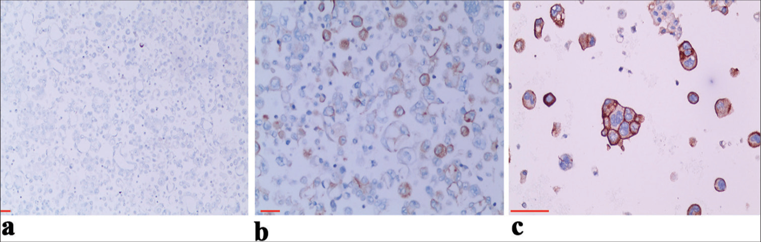 Different levels of programmed death ligand-1 (PD-L1) expression in serous cavity effusion metastatic lung adenocarcinoma. (a) PD-L1 expression (<1%) on immunochemical (IHC) staining in metastatic non-small-cell lung cancer (NSCLC) from pleural effusion, ×10. (b) PD-L1 expression on IHC staining in metastatic NSCLC from pleural effusion (1–49%), ×20. (c) PD-L1 expression (≥50%) in pleural effusion metastatic NSCLC, ×40. Scale bars: 100 μm.