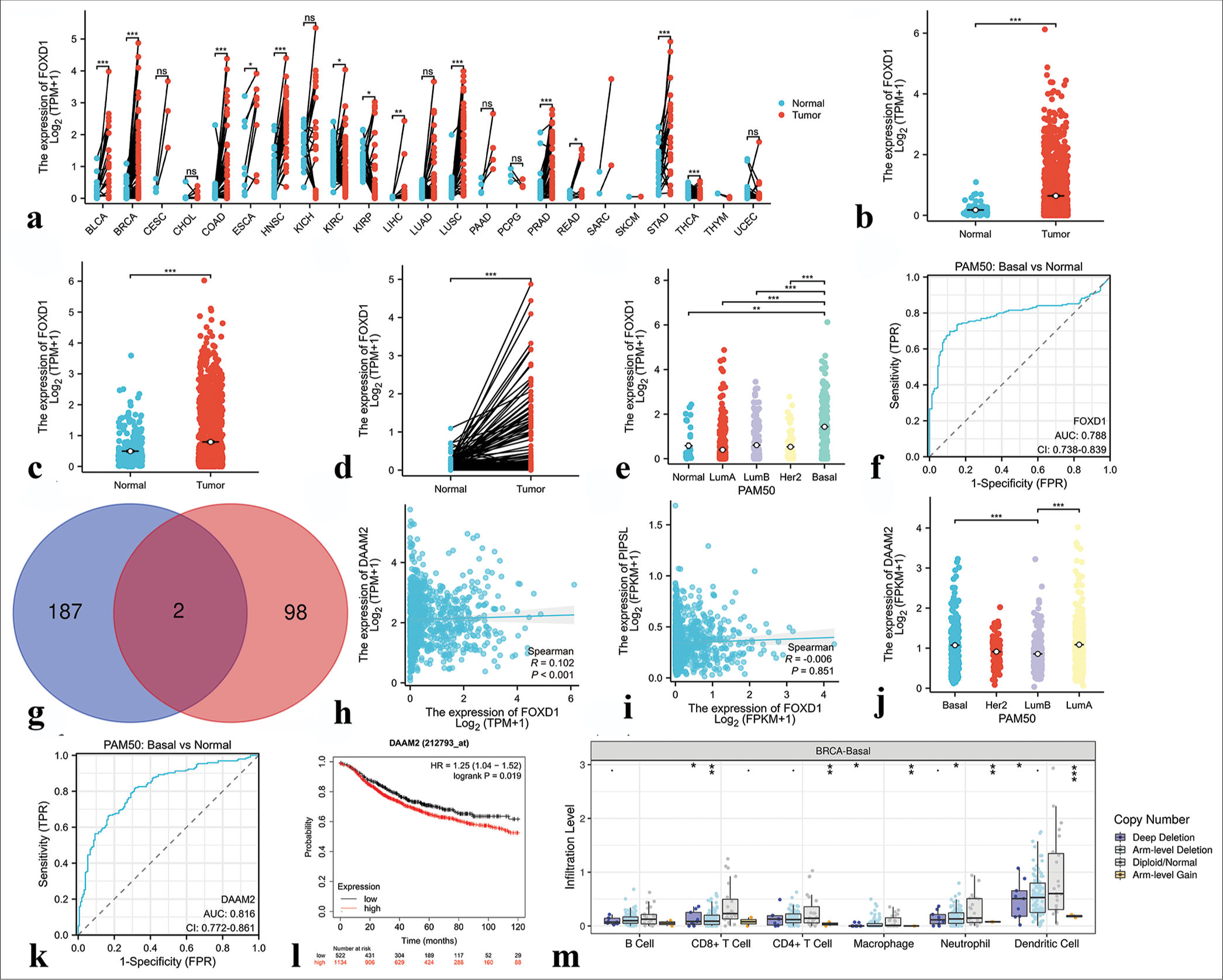 Results of bioinformatics analysis of Forkhead box D1 (FOXD1). (a) Expression of FOXD1 in 23 human tumors. (b and c) The cancer genome atlas (TCGA) and Genotype-Tissue Expression (GTEx) databases demonstrated the expression levels of FOXD1 in BC and normal tissues. (d) FOXD1 expression in breast cancer (n = 113) and paired normal samples (n = 113) collected from the TCGA database. (e) FOXD1 expression in Prediction Analysis of Microarray 50 (PAM50) subtypes. (f) Receiver operating characteristic (ROC) curve based on FOXD1 expression level. (g) Venn diagram of the downstream target genes of FOXD1 shared between the Harmonizome and GRNdb databases (intersection) and those unique to each database. Blue indicates downstream target genes in Harmonizome, pink indicates downstream target genes in GRNdb, and dark red indicates common downstream target genes shared by both databases. (h) Correlation analysis between FOXD1 and the downstream target gene DAAM2. (i) Correlation analysis between FOXD1 and the downstream target gene PIPSL. (j) DAAM2 expression in the PAM50 subtypes. (k) ROC curve based on DAAM2 expression level. (l) Correlation between DAAM2 expression level and prognosis. (m) Correlation analysis of FOXD1 with immune cells in triple-negative breast cancer. ✶P < 0.05, ✶✶P < 0.01, ✶✶✶P < 0.001. FOXD1: Forkhead box D1, AUC: Area under curve, CI: Confidence interval, FPR: False positive rate, PAM50: Prediction analysis of microarray 50, FPKM: Fragments per kilobase of exon per million mapped fragments, TPM: Transcripts per million reads, HR: Hazard ratio, DAAM2: Dishevelled associated activator of morphogenesis 2.