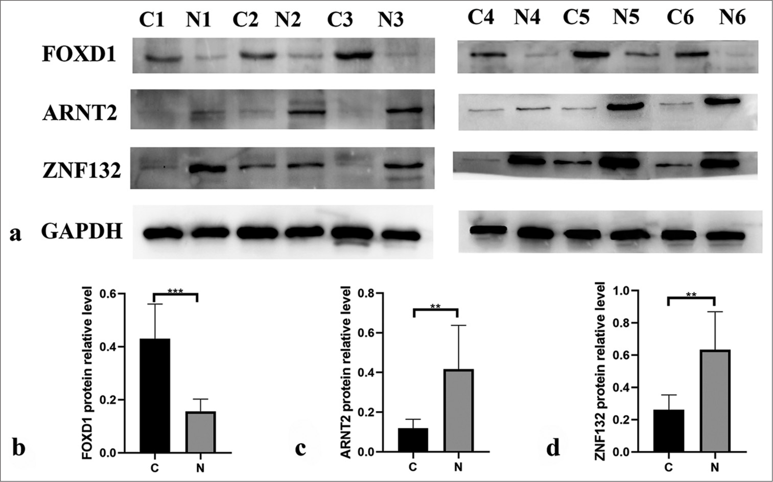 Western blotting showing the protein expression levels of three hub transcription factors in paracancer (n = 6) and cancer tissues (n = 6). (b) Forkhead box D1 (FOXD1), (c) aryl hydrocarbon receptor nuclear translocator 2 (ARNT2), and (d) zinc finger protein (ZNF) 132. ✶✶P < 0.01, ✶✶✶P < 0.001.