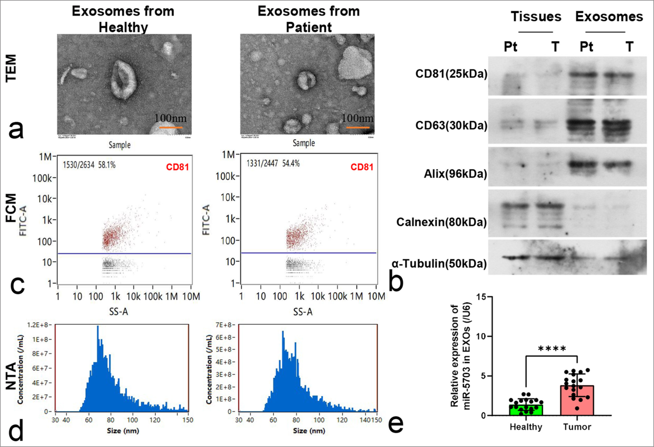 Characterization and microRNA-5703 (miR-5703) quantification of exosomes derived from serum of lung cancer patients and healthy individuals. (a) Electron microscopy image showing exosomes of approximately 100 nm in size, n = 3. (b) Western blotting results of specific exosome markers CD81, CD63, and Alix and negative markers calnexin and α-tubulin, n = 3. Pt: healthy individuals; T: lung cancer patients. (c) Flow cytometry test showing the CD81-positive marker within the exosomes, n = 3. (d) Particle size analysis of the extracted exosomes showing diameters ranging from 50 nm to 120 nm, n = 3. (e) Quantitative polymerase chain reaction results showing significantly higher levels of miR-5703 in the serum exosomes of patients with lung cancer compared with the healthy individuals, n = 20. ✶✶✶✶P < 0.0001 versus health control. SS-A: Side scatter-area