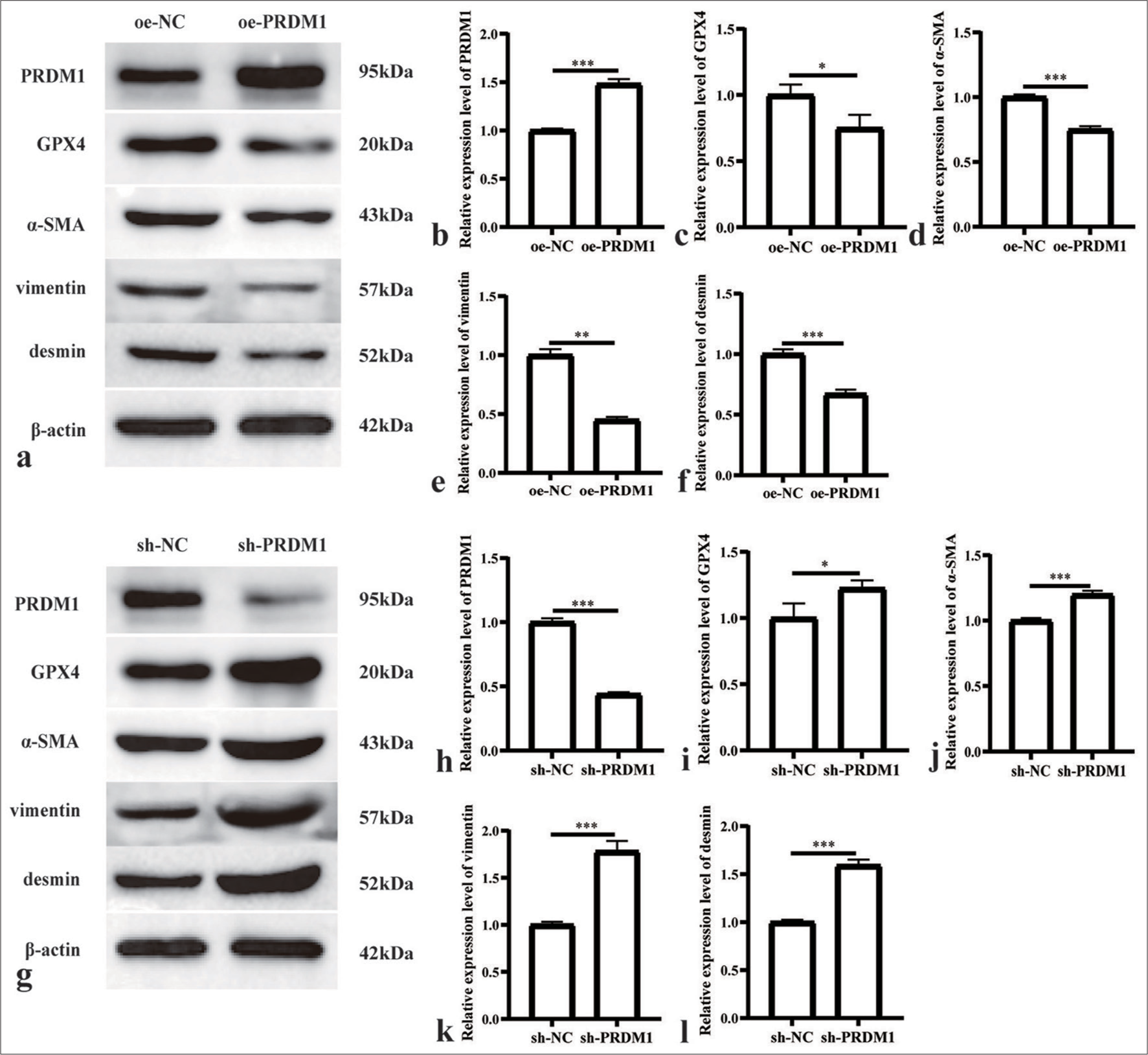 Overexpression of PRDM1 inhibits the activity of HSCs. (a) Western blot plots of PRDM1, GPX4, and HSC cell activation marker proteins alpha smooth muscle actin (α-SMA), vimentin, and desmin in HSCs of the overexpression control (oe-NC) and PRDM1 overexpression (oe-PRDM1) groups. (b-f) Expression of the abovementioned proteins in oe-NC and oe-PRDM1 groups. (g) Western blot plots of PRDM1, GPX4, a-SMA, vimentin, and desmin in HSCs of the interfering control (sh-NC), and PRDM1 interfering (sh-PRDM1) groups. (h-l) Expression of the abovementioned proteins in sh-NC and sh-PRDM1 groups. ✶P<0.05; ✶✶P<0.01; ✶✶✶P<0.001. Each experiment was repeated three times. PRDM1: PR/SET domain 1, GPX4: Glutathione peroxidase 4, ROS: Reactive oxygen species, HSC: Hepatic stellate cells.