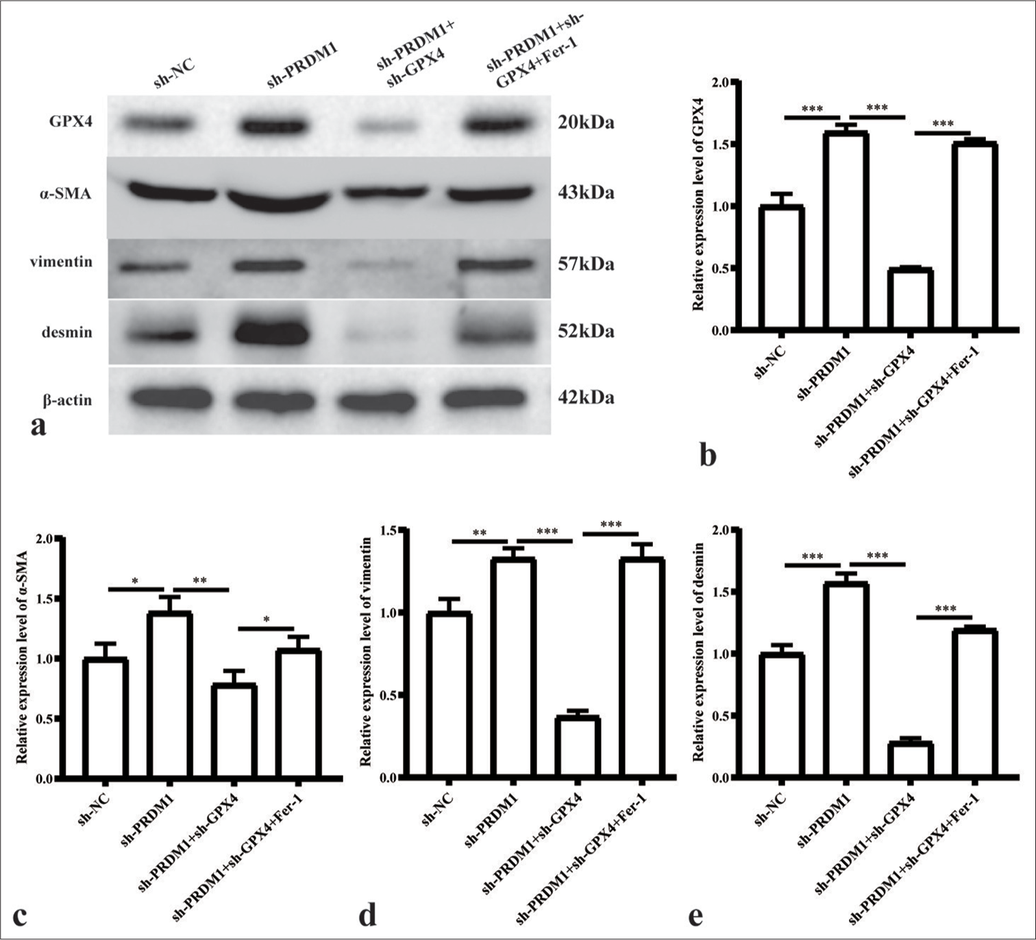 Simultaneous silencing of PRDM1 and GPX4 inhibits the expression of active proteins in HSCs. (a) Western blot plots of GPX4 and HSC cell activation marker proteins a-SMA, vimentin, and desmin in HSCs of the sh-NC, sh-PRDM1, sh-PRDM1 + sh-GPX4, and sh-PRDM1 + sh-GPX4 + Fer-1 groups. (b-e) Statistical graphs of the expression of the abovementioned proteins in different cell groups. ✶: P<0.05; ✶✶: P<0.01; ✶✶✶: P<0.001 for the expression of the abovementioned proteins. Each experiment was repeated three times. PRDM1: PR/SET domain 1, GPX4: Glutathione peroxidase 4, HSC: Hepatic stellate cells, a-SMA: a-smooth muscle actin, Fer-1: Ferroptosis inhibitor, sh-NC: Negative Control, sh-RNA: Short hairpin RNA.