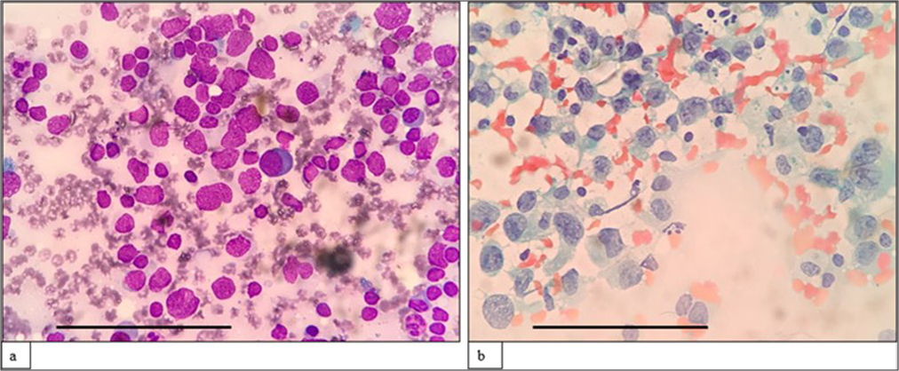 (a) (May–Grünwald–Giemsa; ×1000) and (b) (Papanicolaou; ×1000) fine-needle aspiration cytology: Classic Hodgkin lymphoma- lymphocyte depleted mimicking high-grade lymphoma showing scattered large-sized cells with irregular nuclear membrane, vesicular nuclei, multiple prominent inclusion like nucleoli, and scant to moderate cytoplasm. The scale bar (black line) represents 100 μm.