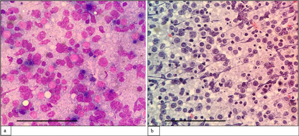 (a) (May–Grünwald–Giemsa; ×400) and (b) (Papanicolaou; ×400) fine-needle aspiration cytology: Blastoid Mantle cell lymphoma of cutaneous swelling showing sheets of monomorphic intermediatesized cells with dispersed chromatin, inconspicuous nucleoli and scant cytoplasm. The scale bar (black line) represents 100 μm.