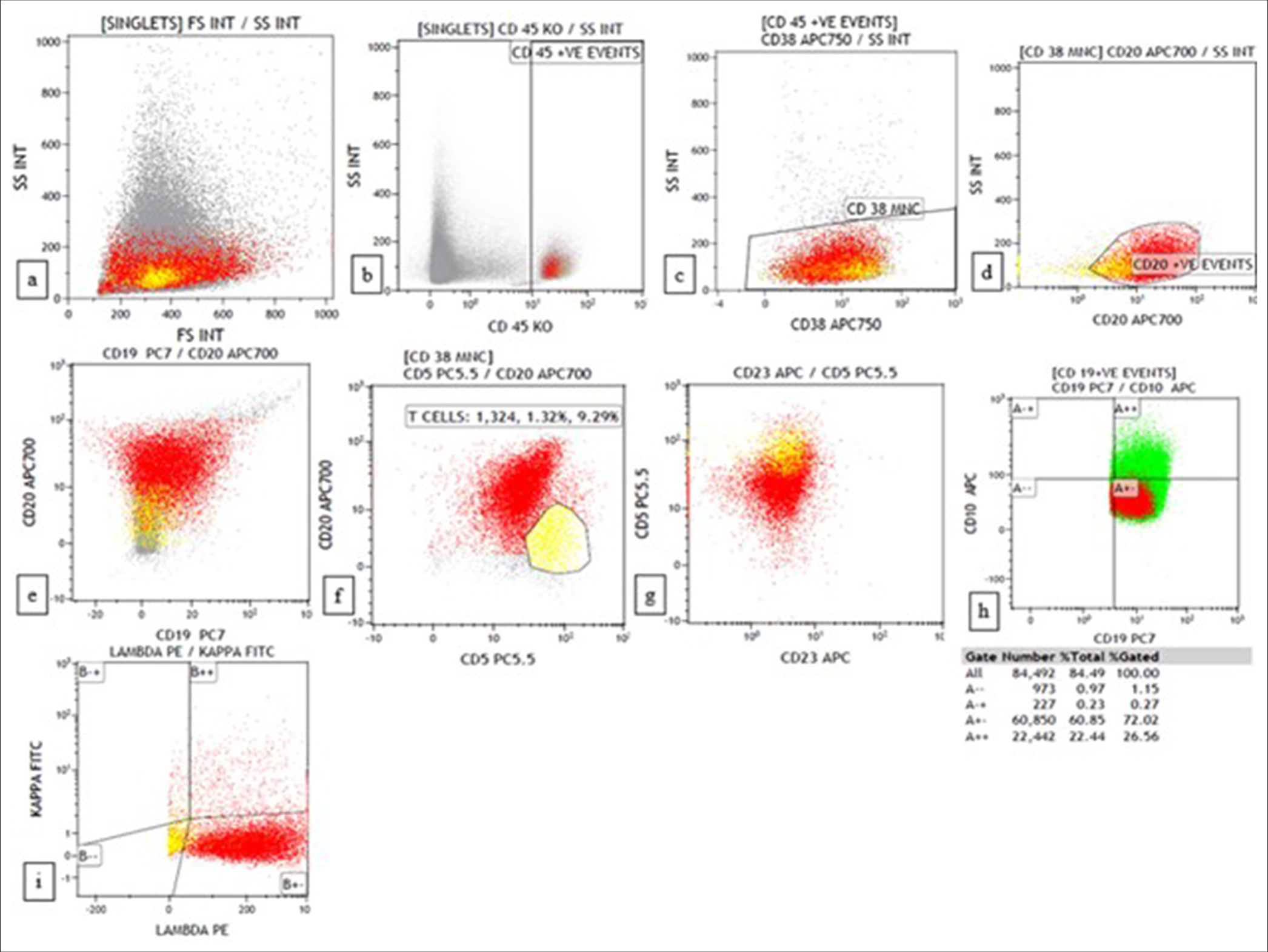 Flow cytometry plots of blastoid mantle cell lymphoma show CD20+, CD19+, CD5+, CD23-, CD10+ (weak), and lambda restricted. (a) forward scatter (FSC) versus side scatter (SSC) (b) CD45 versus SSC (c) CD38 versus SSC (d) CD20 versus SSC (e) CD19 versus CD20 (f) CD20 versus CD5 (g) CD5 versus CD23 (h) CD19 versus CD10 (i) Kappa versus lambda.