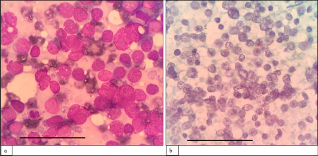 (a) (May–Grünwald–Giemsa; ×400) and (b) (Papanicolaou; ×400) fine-needle aspiration cytology: Peripheral T cell lymphoma shows sheets of small to medium-sized cells with irregular nuclear membranes, coarse chromatin, inconspicuous nucleoli, and scant cytoplasm. The scale bar (black line) represents 100 μm.