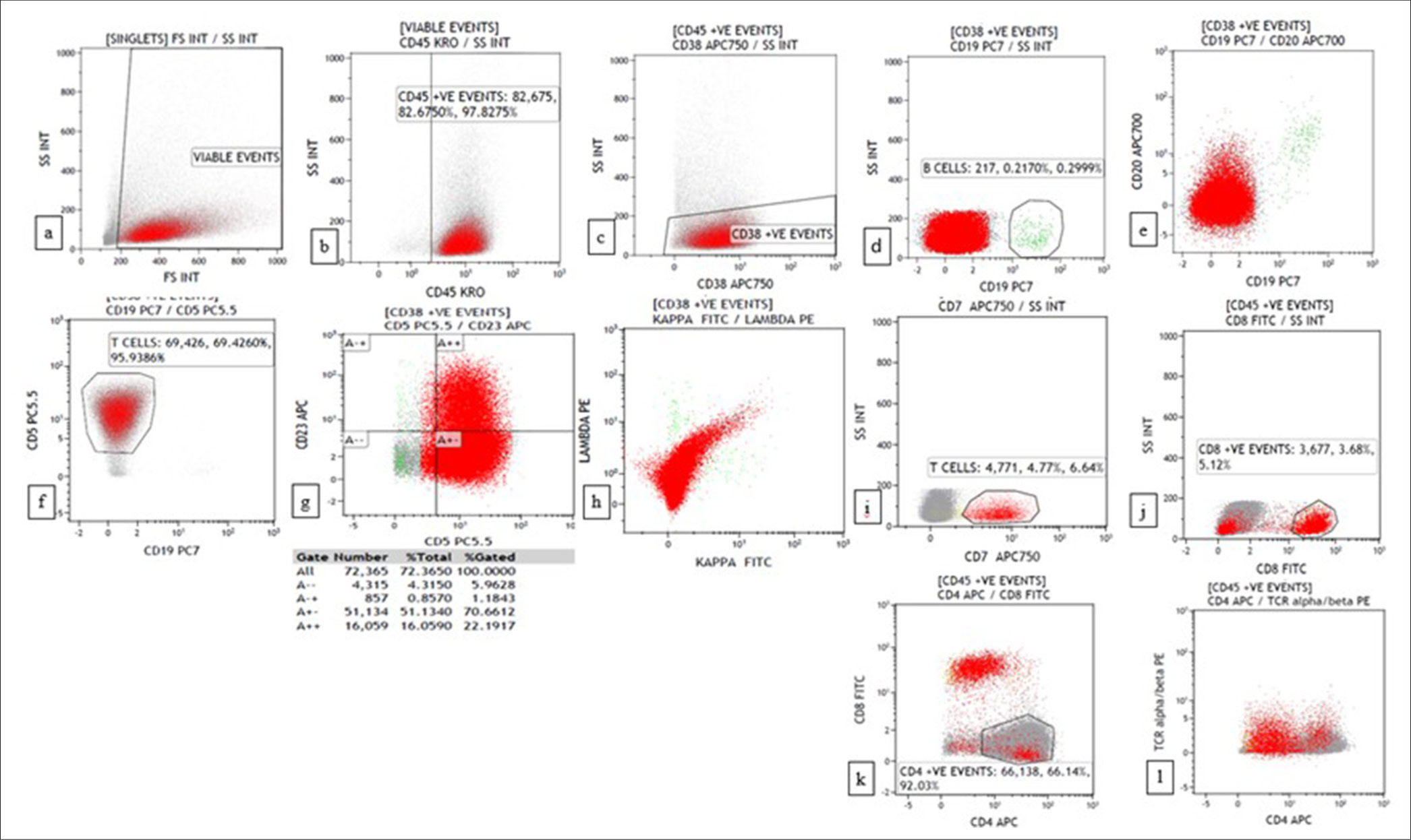 Flow cytometry plots of Peripheral T cell lymphoma showing CD45+, CD19-, CD20-, CD5+ (bright), CD23 (dim+), CD7-, CD8-, CD4+ (92%), T-cell receptor alpha/beta (TCRα/β) (dim+). (a) forward scatter (FSC) versus side scatter (SSC) (b) CD45 versus SSC (c) CD38 versus SSC (d) CD19 versus SSC (e) CD19 versus CD20 (f) CD19 versus CD5 (g) CD5 versus CD23 (h) Kappa versus lambda (i) CD7 versus SSC (j) CD8 versus SSC (k) CD4 versus CD8 (l) CD4 versus TCRα/β.