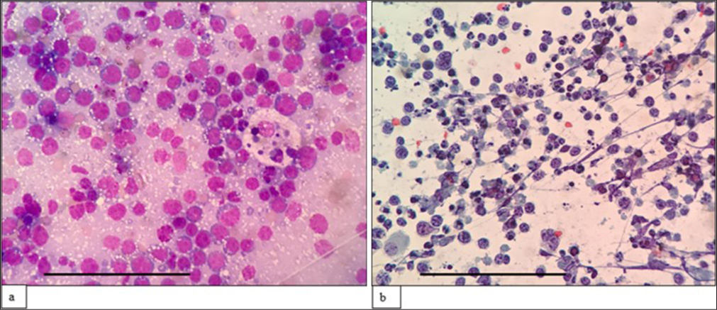 (a) (May–Grünwald–Giemsa; ×400) and (b) (Papanicolaou; ×400) fine-needle aspiration cytology: Burkitt lymphoma showing monomorphic medium-sized cells with round nuclei, coarse chromatin, multiple tiny nucleoli with deep basophilic cytoplasm showing cytoplasmic vacuoles and tingible body macrophage. The scale bar (black line) represents 100 μm.