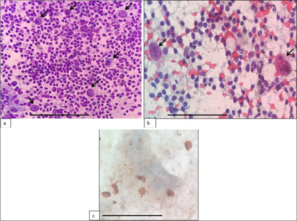 (a) (May–Grünwald–Giemsa; ×400) and (b) (Papanicolaou; ×400) fine-needle aspiration cytology: Classic Hodgkin lymphoma showing scattered mononuclear Reed Sternberg cells (black arrows) in a background of the polymorphous population of lymphocytes. (c) (Diaminobenzidine; ×400) CD30 immunocytochemistry done on alcohol-fixed smear highlights R-S cells. The scale bar (black line) represents 100 μm.