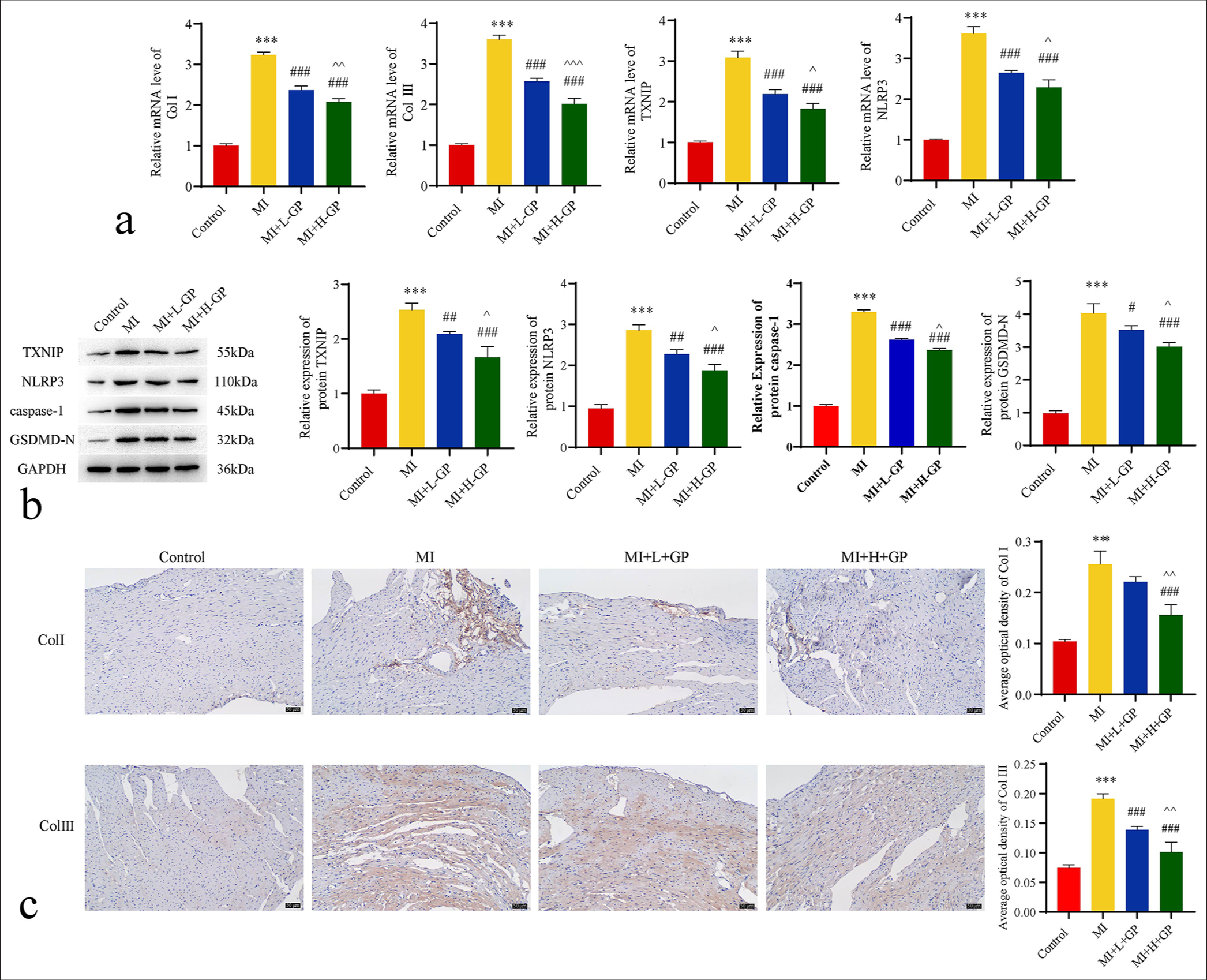 Expressions of type I collagen (Col I)/type III collagen (Col III)/apoptosis-related genes in mouse myocardial tissues of each group (n = 3). (a) Quantitative polymerase chain reaction assessed the expression of Col I, Col III, thioredoxin-interacting protein (TXNIP), and NLRP3 mRNA. (b) Western blot evaluated protein expressions of TXNIP, NLRP3, caspase-1, and gasdermin D N (GSDMD-N)-terminal. (c) Immunohistochemistry (IHC) staining detected the protein expression levels of Col I and Col III (IHC: ×200, scale bar = 50 µm). Compared with the control group, ✶✶✶P< 0.001; as compared with the myocardial infarction (MI) group, #P < 0.05, ##P < 0.01, ###P < 0.001; as compared with the MI+L-Geniposide (L-GP) group, ^P < 0.05, ^^P < 0.01, ^^^P < 0.001. NLRP3: NOD-like receptor protein 3, GAPDH: Glyceraldehyde-3-phosphate dehydrogenase, H-GP: High geniposide.