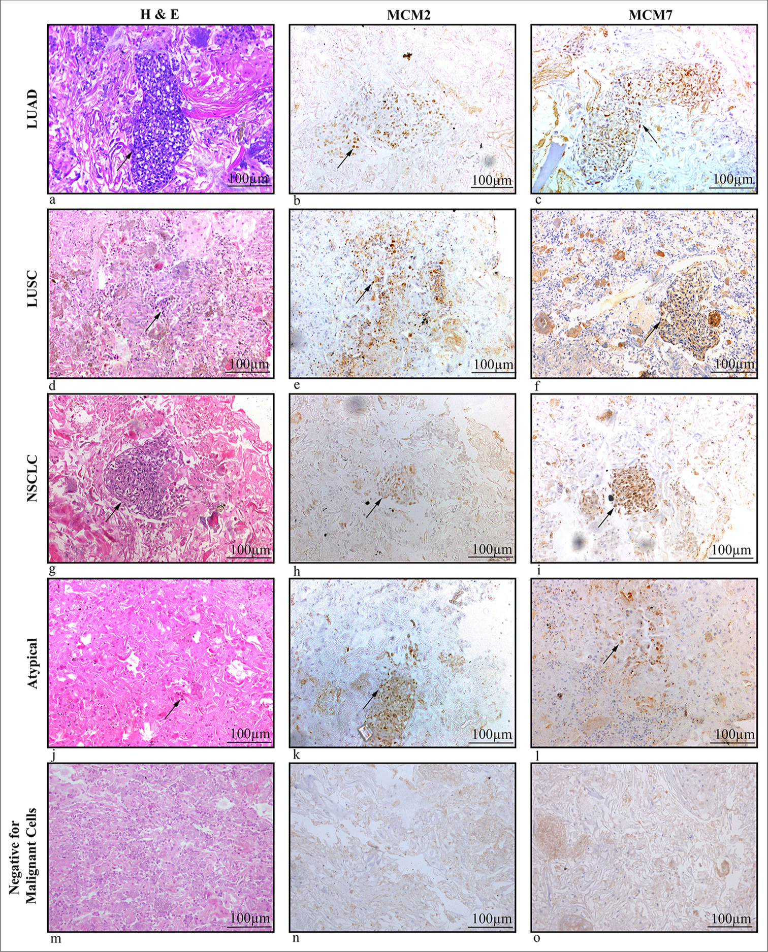 (a-o) Cellblock sections of sputum samples of lung cancer patients showing MCM2 and MCM7 expressions. (a, d, g, j, m) H&E, magnification 20x of sputum cell blocks in LUAD, LUSC, NSCLC, Atypical and NMC subtypes. (b) Moderate nuclear expression of MCM2 in Adenocarcinoma cells. (c) Dense nuclear expression of MCM7 in Adenocarcinoma cells. (e and f) Moderate nuclear expression of MCM2 and MCM7 in squamous cell carcinoma cells. (h and i) Mild nuclear expression of MCM2 and MCM7 in NSCLC cells. (k and l) Weak/Mild nuclear expression of MCM2 and MCM7 in atypical cells. (n and o) MCM2 and MCM7 negative in non-malignant samples (Scale bar- 100 µm). The arrow points the malignant cells in the cellblock. (H&E: Hematoxylin and eosin, MCM2: Minichromosome maintenance protein 2, MCM7: Minichromosome maintenance protein 7, LUAD: Lung adenocarcinoma, LUSC: Lung squamous cell carcinoma, NSCLC: Non-small cell lung carcinoma, NMC: Negative for malignant cells).