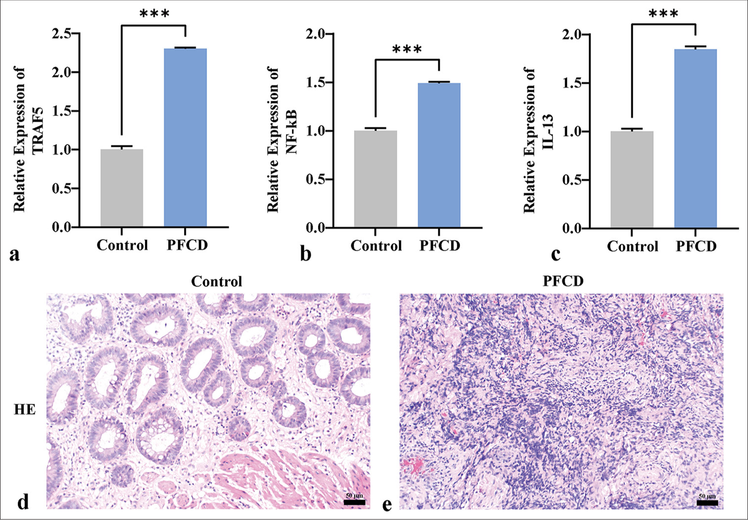 qPCR and HE staining reveal the expression of TRAF5 in PFCD and EMT. (a-c) qPCR detection of TRAF5, NF-κB, and IL-13 mRNA expression levels. (d and e) HE staining depicting the pathological morphology of each group (×200) (scale bar = 50 μm). ✶✶✶P < 0.001, n = 3. TRAF5: Tumor necrosis factor receptor-associated factor 5, NF-κB: Nuclear factor kappa B, IL-13: Interleukin 13, PFCD: Perianal fistulizing Crohn’s disease, HE: Hematoxylin and eosin, qPCR: Quantitative polymerase chain reaction, EMT: Epithelial–mesenchymal transition.