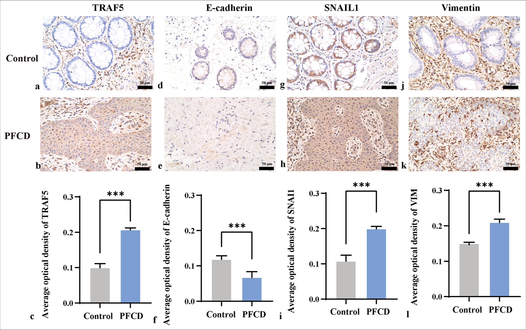 Immunohistochemistry was used to detect the expression levels of TRAF5, E-cadherin, SNAIL1, and vimentin (×400) in each group (scale bar = 50 μm). (a-b, d-e, g-h, and j-k) Immunohistochemical staining of the intestine; (c, f, i, and l) TRAF5, E-cadherin, SNAIL1 and vimentin protein expression levels, ✶✶✶P < 0.001. E-cadherin: Epithelial cadherin, SNAIL1: Snail family transcriptional repressor 1, VIM: Vimentin, TRAF5: Tumor necrosis factor receptor-associated factor 5.