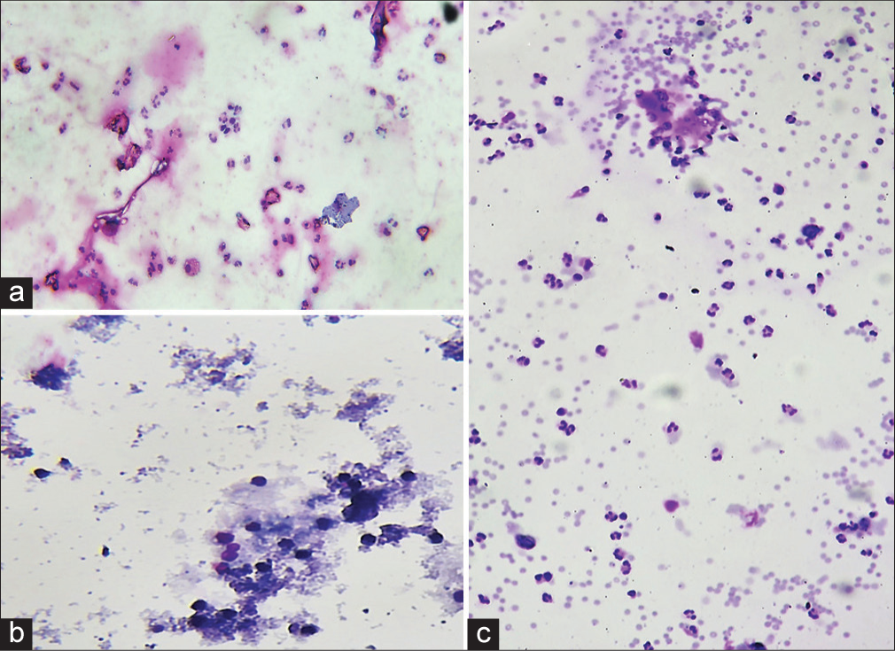 Saline rehydration technique showed hemolysis of RBCs, however, background haziness and distortion of cells (a) (May Grunwald Giemsa, 400x), (b) (May Grunwald Giemsa, 100x) as compared to (c) control slide (May Grunwald Giemsa, 100x).