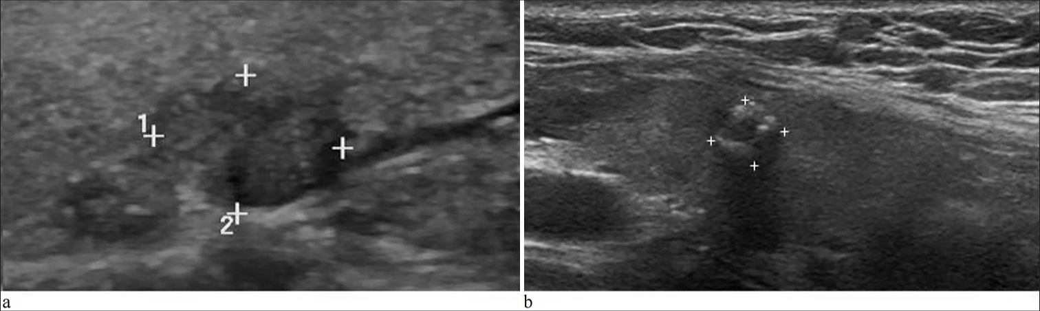 Illustration of benign thyroid nodules with Bethesda system for reporting thyroid cytopathology I and positive BRAF mutation. Ultrasound of the neck reveals that: (a) A dysplasia nodule in the left lobe with the size of 10 × 7 × 8 mm (thyroid imaging reporting and data system [TI-RADS] 4B). (b) A fibrotic nodule in the right lobe with the size of 6 × 5 × 5 mm (TI-RADS 4A).