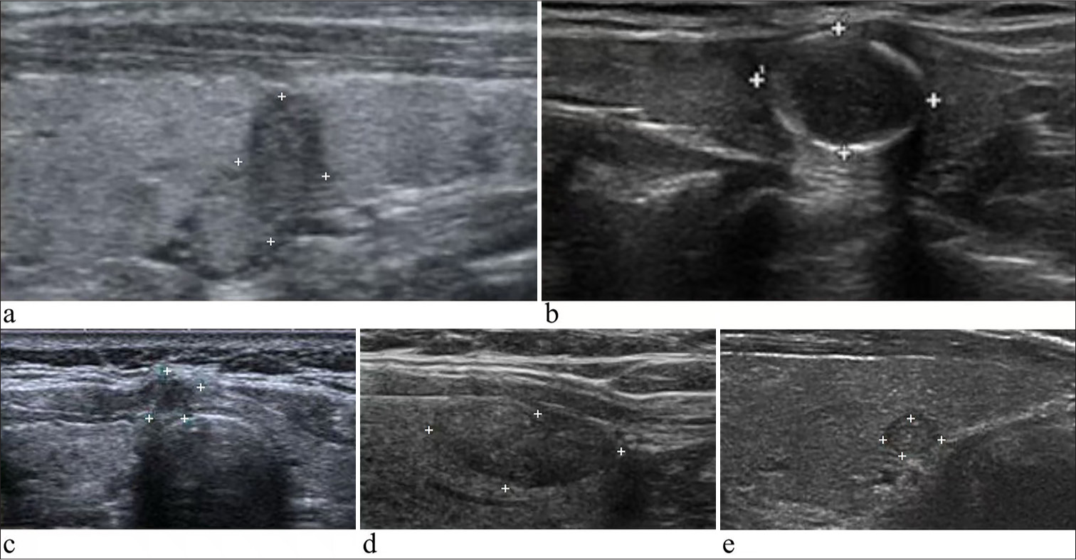 Illustration of benign thyroid nodules with Bethesda system for reporting thyroid cytopathology III and positive BRAF mutation. Ultrasound of the neck reveals that: (a) A dysplasia nodule in the left lobe with the size of 7 × 4 × 3 mm (thyroid imaging reporting and data system [TI-RADS] 4A). (b) A dysplasia nodule in the right lobe with the size of 15 × 10 × 10 mm (TI-RADS 4A). (c) A dysplasia nodule in the right lobe with the size of 4 × 4 × 5 mm (TI-RADS 4B). (d) An adenomatous nodule in the left lobe with the size of 19 × 9 × 14 mm (TI-RADS 4A). (e) A dysplasia nodule in the right thyroid with the size of 5 × 4 × 4 mm (TI-RADS 4A).