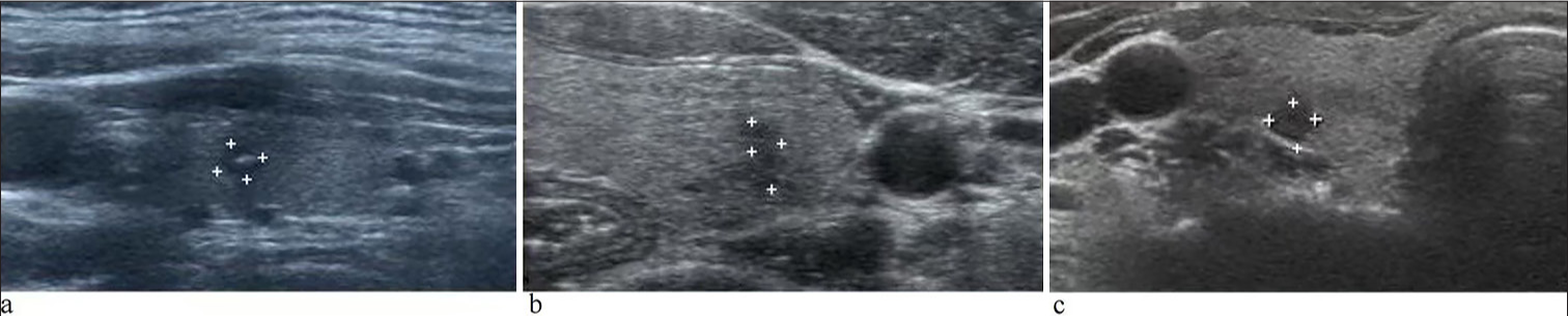 Illustration of benign thyroid nodules with Bethesda system for reporting thyroid cytopathology V and negative BRAF mutation. Ultrasound of the neck reveals that: (a) A dysplasia nodule in the left lobe with the size of 4 × 5 × 5 mm (thyroid imaging reporting and data system [TIRADS] 4A). (b) A dysplasia nodule in the left thyroid with the size of 5 × 5 × 3 mm (TI-RADS 4A). (c) A hyperplastic nodule in the right thyroid with the size of 4 × 5 × 4 mm (TI-RADS 4C).