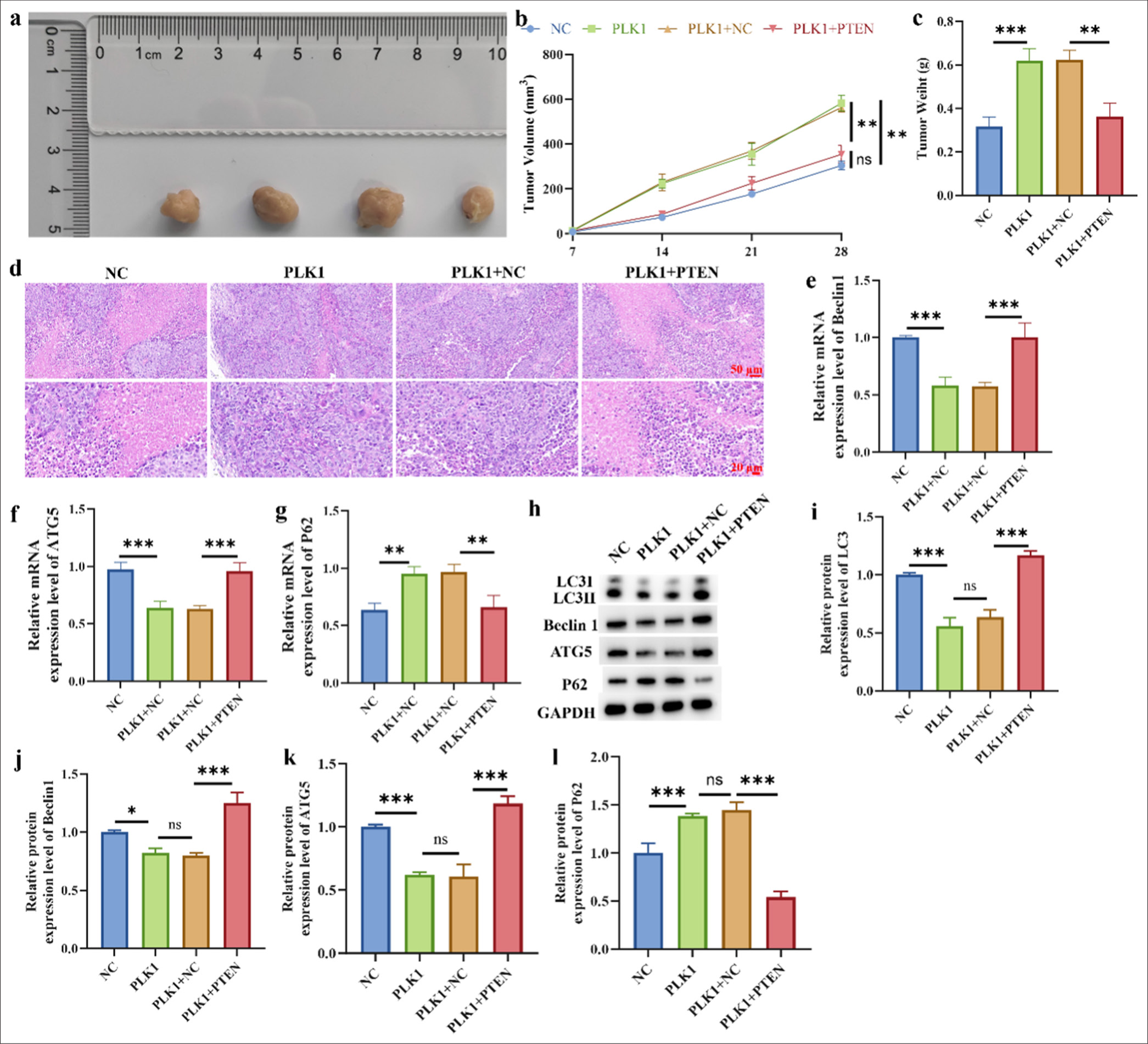 Relationship between PLK1 and PTEN in xenograft tumor models. (a) A549 cell xenoinhibitory tumor representation. (b and c) Tumor weight and volume. (d) H&E staining of tumor tissue. (e-g) mRNA level of Beclin1, AGT5, and P62. (h-l) Protein level of LC3, Beclin1, AGT5 and P62. n = 3 (ns: No statistical difference, ✶P < 0.05, ✶✶ P < 0.01, ✶✶✶P < 0.001). H&E: Hematoxylin and eosin, LC3: Light chain 3, ATG5: Autophagy protein 5.