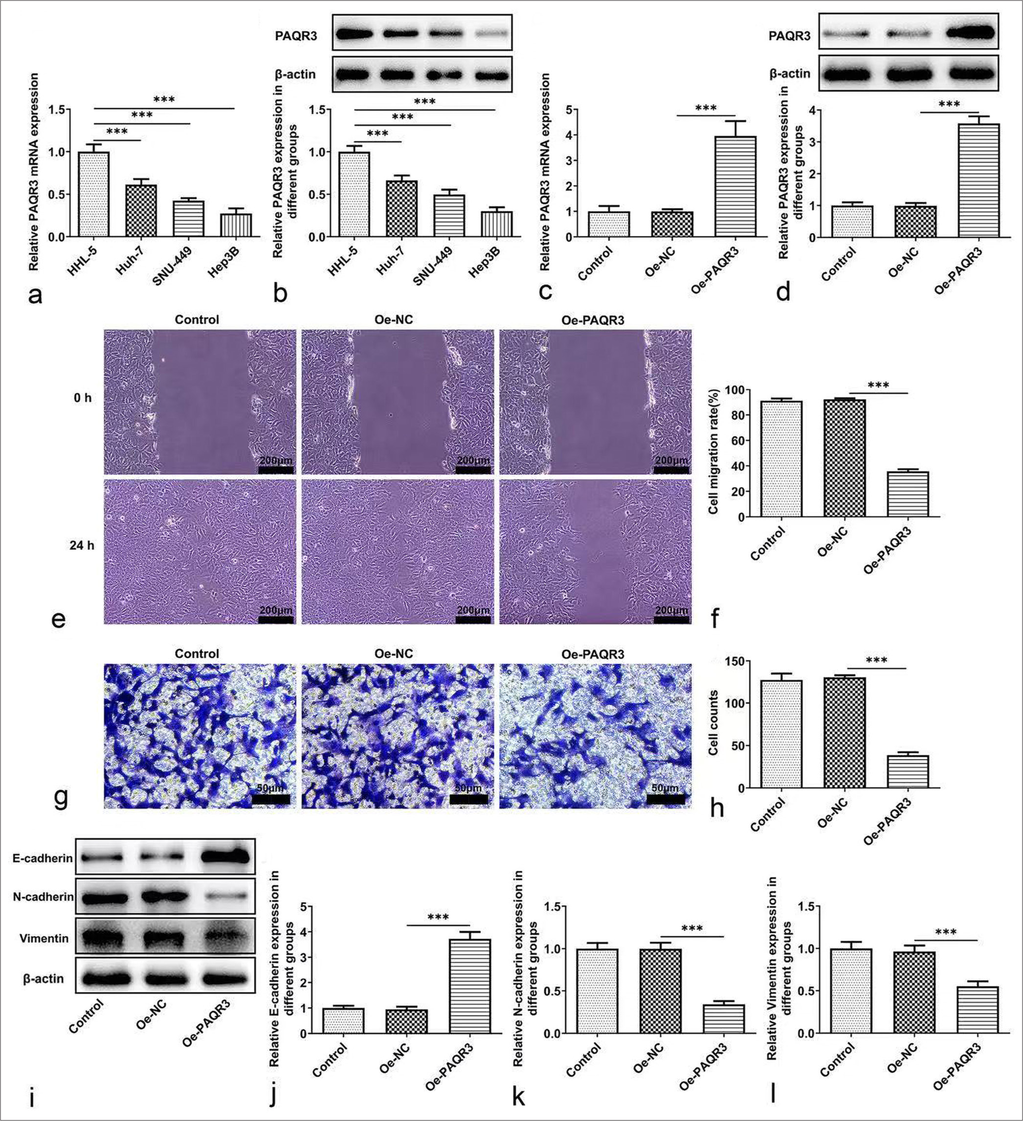 Overexpression of PAQR3 inhibits HCC cell metastasis. (a, b) Relative PAQR3 expression in HCC cells. (c, d) Relative PAQR3 expression following transfection with Oe-PAQR3 in HCC cells. (e, f) Cell migration was assessed by wound healing assay (scale bars: 200 μm). Data are representative of three independent experiments. (g, h) Cell invasion was assessed using transwell chamber assay (scale bars: 50 μm). Results are from three independent experiments performed in triplicate. (i-l) Protein levels of EMT-related proteins E-cadherin, N-cadherin and Vimentin were estimated by western blotting. Blots are representative of three independent experiments. ✶✶✶: P < 0.001, ns, not significant. PAQR3: Progestin and adipoQ receptor 3, HCC: Hepatocellular carcinoma, EMT: Epithelial-mesenchymal transition, Oe-NC: Overexpression negative control.