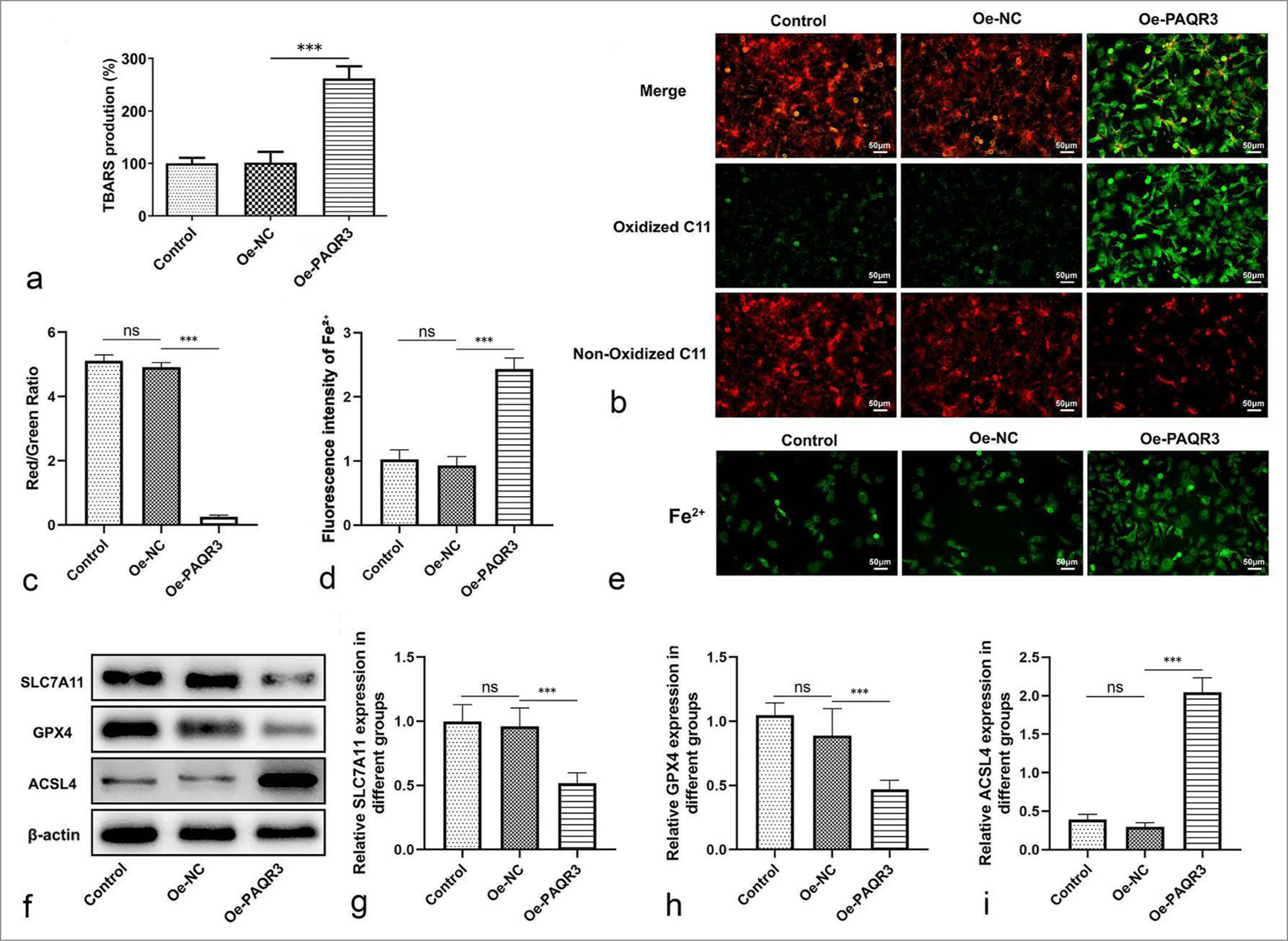 Effects of PAQR3 overexpression on ferroptosis in HCC cells. (a) Lipid peroxidation levels measured by TBARS assay. (b, c) ROS levels detected by C11-BODIPY staining (red/green ratio; scale bars: 50 μm). (d, e) Intracellular Fe2+ levels assessed by fluorescence intensity (scale bars: 50 μm). (f) Representative western blot bands of ferroptosis-related proteins (SLC7A11, GPX4, ACSL4, and b-actin). (g) Quantification of relative SLC7A11 expression. (h) Quantification of relative GPX4 expression. (i) Quantification of relative ACSL4 expression. ✶✶✶P < 0.001, ns: Not significant. Data in (a, g, h, i) are presented as mean±standard deviation from three independent experiments. Data in (b-e) and blot in (f) are representative of three independent experiments. PAQR3: Progestin and adipoQ receptor 3, HCC: Hepatocellular carcinoma, TBARS: Thiobarbituric acid reactive substance, ROS: Reactive oxygen species, Oe-NC: Overexpression negative control.