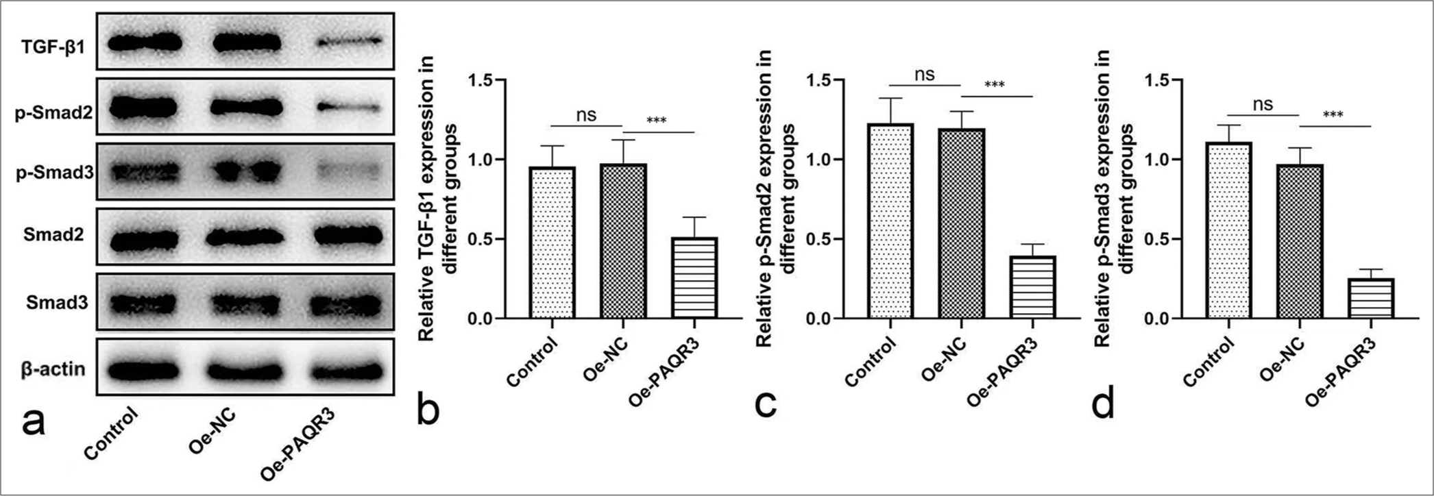 Effects of PAQR3 overexpression on the TGF-b pathway in HCC cells. (a) Representative western blot analysis of TGF-b1, p-Smad2, p-Smad3, Smad2, and Smad3 expression in HCC cells. (b) Quantification of relative TGF-b1 protein expression. (c) Quantification of relative p-Smad2 protein expression. (d) Quantification of relative p-Smad3 protein expression. ✶✶✶P < 0.001, ns: Not significant. The blot in (a) is representative of three independent experiments. Quantitative data in (b-d) are presented as mean±standard deviation from three independent experiments. PAQR3: Progestin and adipoQ receptor 3, HCC: Hepatocellular carcinoma, TGF-b: Transforming growth factor-b, Oe-NC: Overexpression negative control.