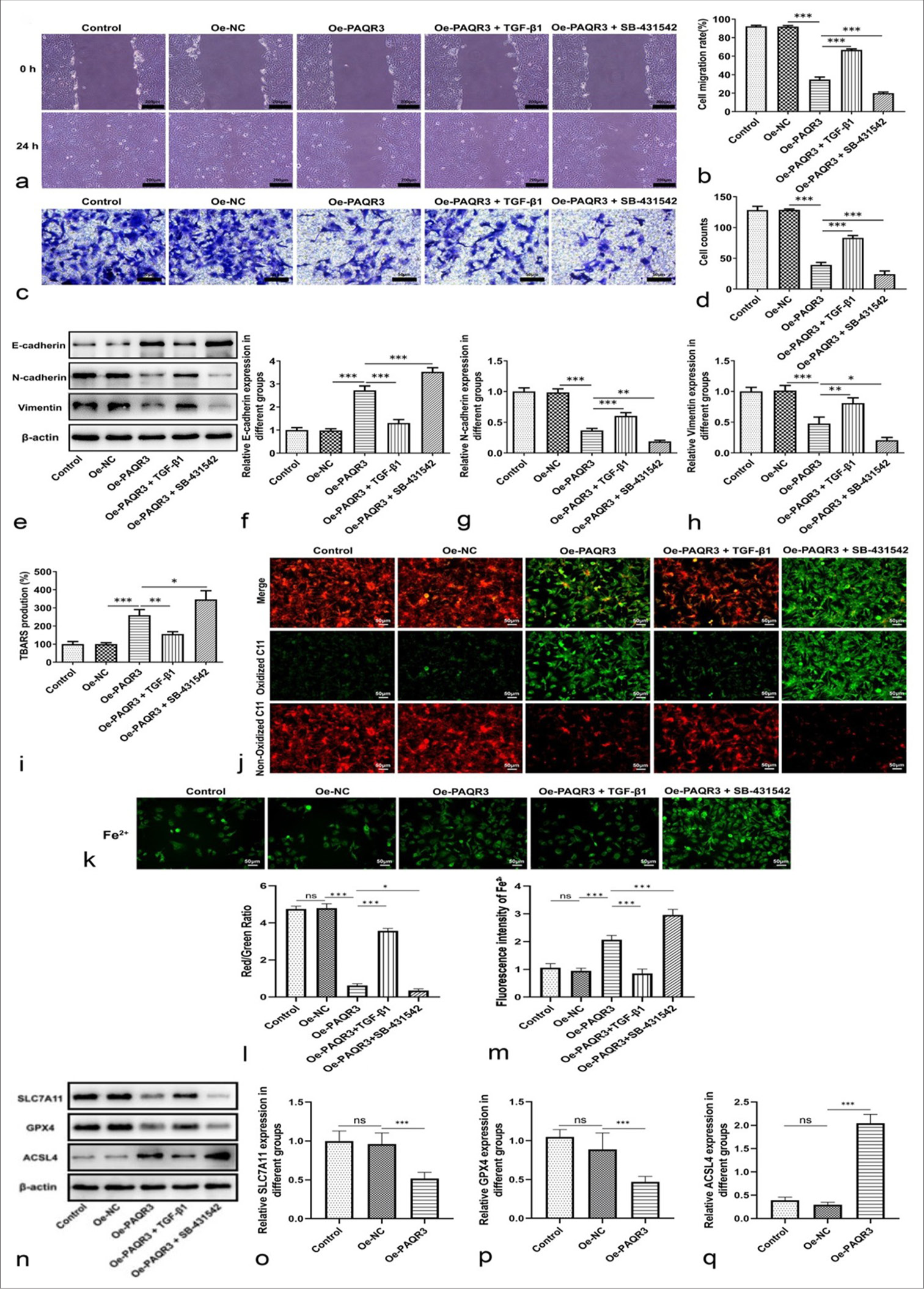 PAQR3 regulates HCC cell metastasis and ferroptosis through the TGF-b pathway. (a) Wound healing assay images showing cell migration in different groups (scale bars: 200 μm). (b) Quantification of cell migration rates from wound healing assay. (c) Transwell invasion assay images of HCC cells in different groups (scale bars: 50 μm). (d) Quantification of invaded cell counts from the Transwell assay. (e) Representative Western blot images of EMT-related proteins (E-cadherin, N-cadherin, Vimentin, b-actin). (f) Quantification of relative E-cadherin expression. (g) Quantification of relative N-cadherin expression. (h) Quantification of relative Vimentin expression. (i) TBARS assay showing lipid peroxidation levels. (j) C11-BODIPY staining showing ROS levels (merge, oxidized C11, non-oxidized C11, scale bars: 50 μm). (k) Representative images of intracellular Fe2+ fluorescence (scale bars: 50 μm). (l) Quantification of red/green fluorescence ratio for ROS levels. (m) Quantification of intracellular Fe2+ fluorescence intensity. (n) Representative western blot images of ferroptosis-related proteins (SLC7A11, GPX4, ACSL4, b-actin). (o) Quantification of relative SLC7A11 expression. (p) Quantification of relative GPX4 expression. (q) Quantification of relative ACSL4 expression. ✶P < 0.05, ✶✶P < 0.01, ✶✶✶P < 0.001, ns: Not significant. Images in (a, c, e, j, k, n) are representative of three independent experiments. Quantitative data in (b, d, f-h, i, l, m, o-q) are presented as mean±SD from three independent experiments. PAQR3: Progestin and adipoQ receptor 3, HCC: Hepatocellular carcinoma, EMT: Epithelial-mesenchymal transition, TBARS: Thiobarbituric acid reactive substance, Oe-NC: Overexpression negative control.