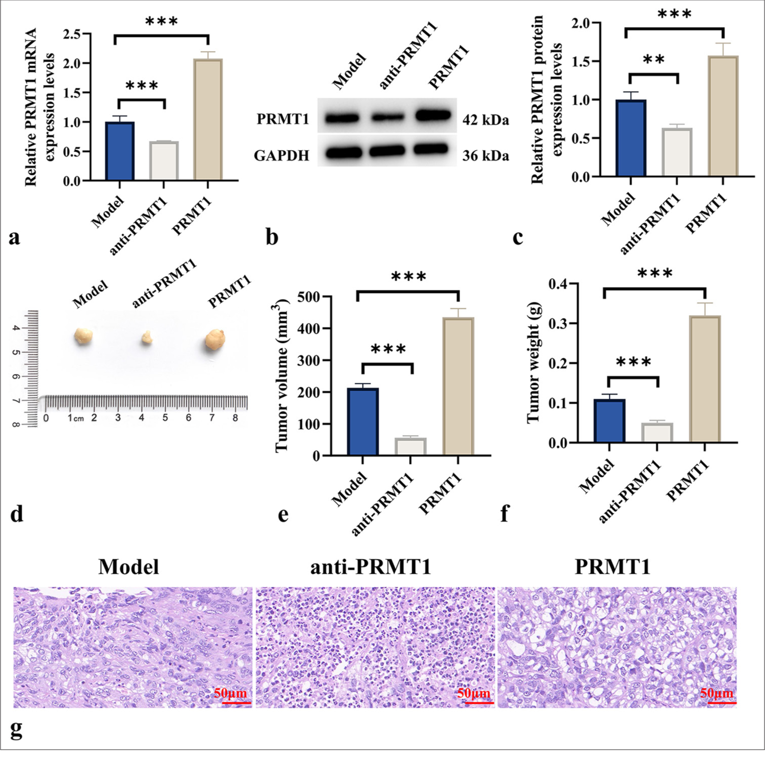 PRMT1 promotes tumor growth in cervical cancer. (a-c) PRMT1 mRNA and protein levels in tumor tissues were measured following treatment of CC mice with anti-PRMT1 or PRMT1 recombinant protein. (d-f) Tumor images, volumes, and weights were obtained after treatment with anti-PRMT1 or PRMT1 in CC mice. (g) HE staining of tumor tissues. Scale bar: 50 μm. Magnification: ×400. n = 6. ✶✶P < 0.01, ✶✶✶P < 0.001. PRMT1: Protein arginine methyltransferase 1, mRNA: Messenger RNA, CC: Cervical cancer, HE: Hematoxylin and eosin.