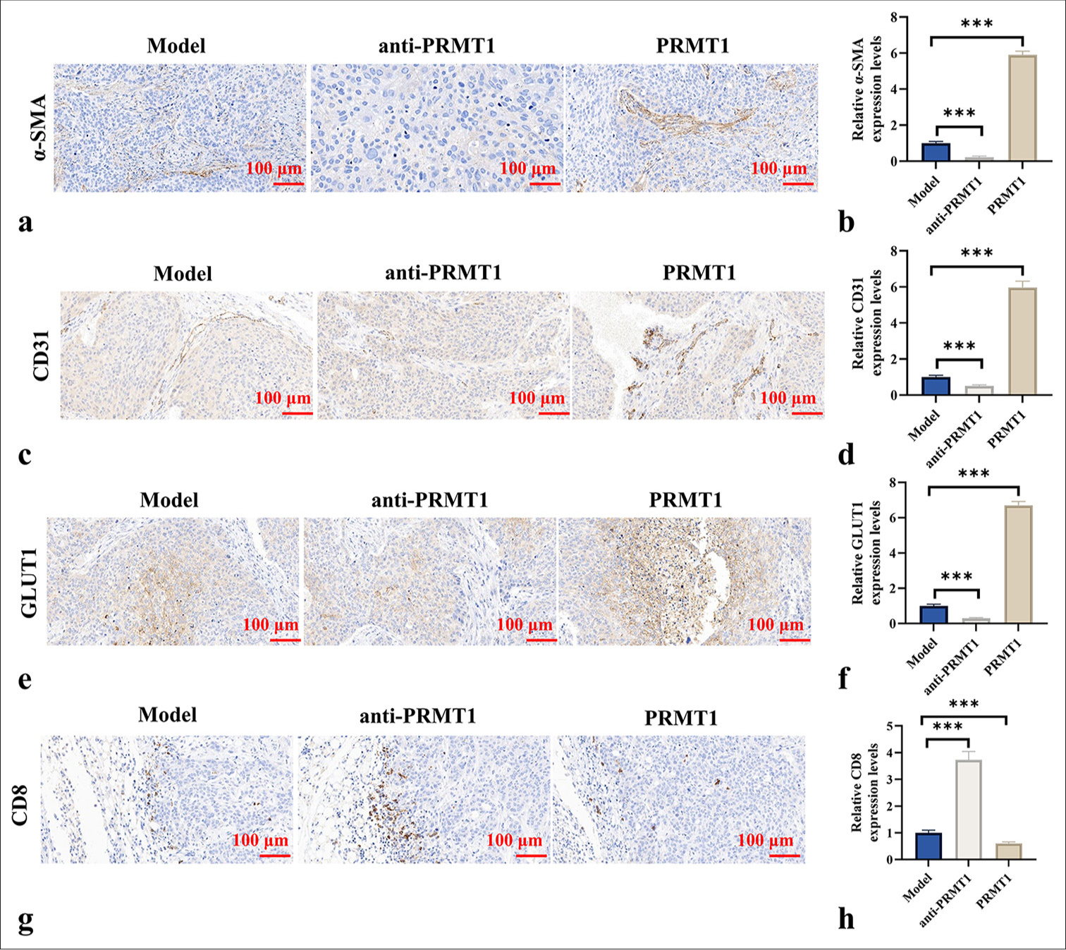 PRMT1 promotes angiogenesis and suppresses immune responses in c tumors. (a-h) Immunohistochemical analysis of a-SMA, CD31, CD8, and GLUT1 expression in tumor tissues. Scale bar: 100 μm. Magnification: ×200. n = 6, ✶✶✶P < 0.001. PRMT1: Protein arginine methyltransferase 1, a-SMA: Alpha-smooth muscle actin, CD31: Cluster of differentiation 31, GLUT1: Glucose transporter 1, CD8: Cluster of differentiation 8.