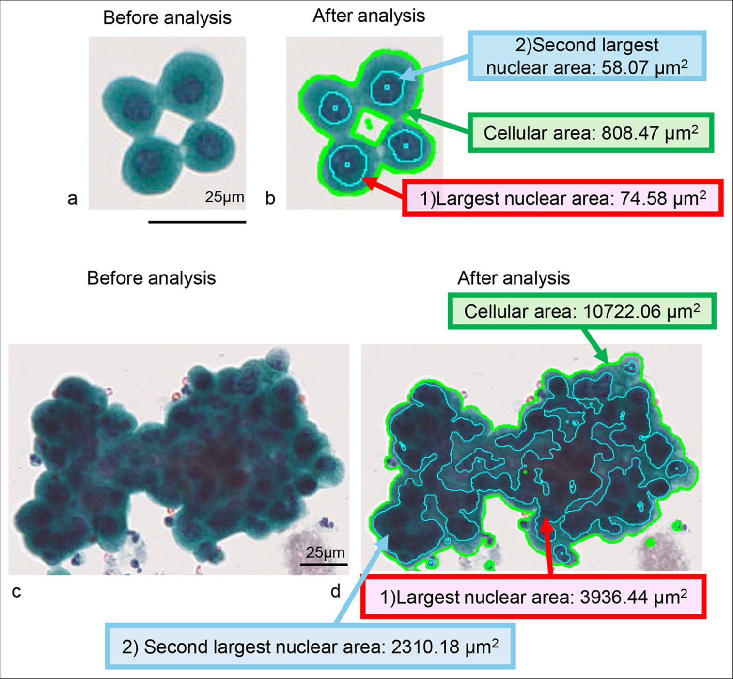 Example of computer-assisted image analysis for normal urothelial cells and high-grade urothelial carcinoma (HGUC) cell clusters. (a and b) Normal urothelial cell cluster (Case 17). (c and d) HGUC case (Case 77). (a and c) show images before analysis, while (b and d) display images after analysis. The cellular area of the normal urothelial cell cluster in the analyzed image is outlined by the light green line, and the individually detectable nuclear areas are framed by the light blue line (b). The light green line outlines the cellular area of the carcinoma cell cluster in the analyzed image, and the individually detectable nuclear-connected area is framed by the light blue line (d). The actual cellular area data in (b and d) are highlighted with a green background and green line, while the largest nuclear area data in the cell cluster in (b and d) are highlighted with a red background and red arrow. The second-largest nuclear area data in the cell cluster in (b and d) are highlighted with a blue background and blue line. Thus, the largest nuclear area/cellular area in b) is 9.22%, and the one in d) is 36.71%.