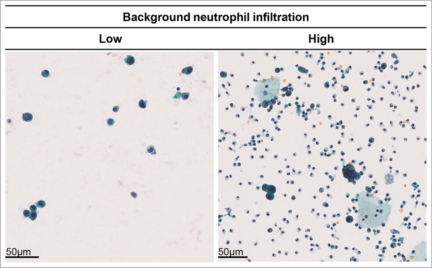 Comparison of background neutrophil infiltration levels and tumor invasion depth. Left: Example of low background neutrophil infiltration (Case 123). Right: Example of high background neutrophil infiltration (Case 187).