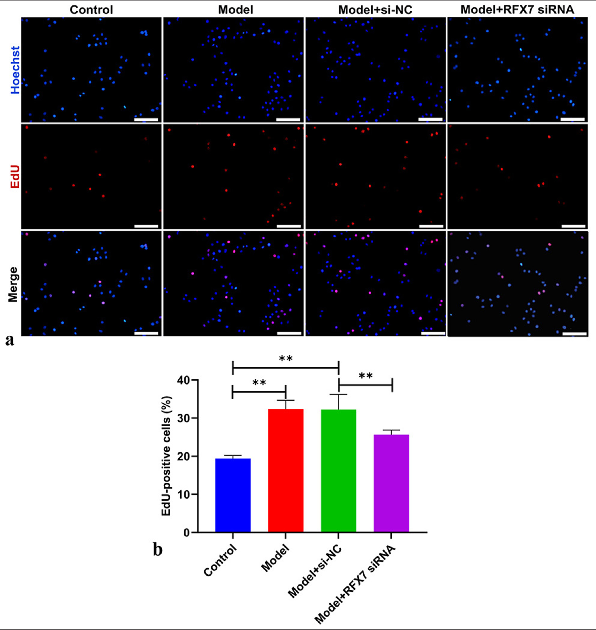 Regulatory factor X7 (RFX7) knockdown alleviates platelet-derived growth factor-BB (PDGF-BB)-triggered airway smooth muscle cell (ASMC) proliferation. (a) Representative images of 5-ethyny-2'-deoxyuridine (EdU) assay in ASMCs in the context of PDGF-BB administration or RFX7 Small interfering RNAs (siRNA) transfection. Scale bar, 50 μm. (b) Quantification analysis of EdU-positive ASMCs with PDGF-BB administration or RFX7 siRNA transfection. ✶✶P < 0.01. The experiment was repeated 3 times, n = 3.