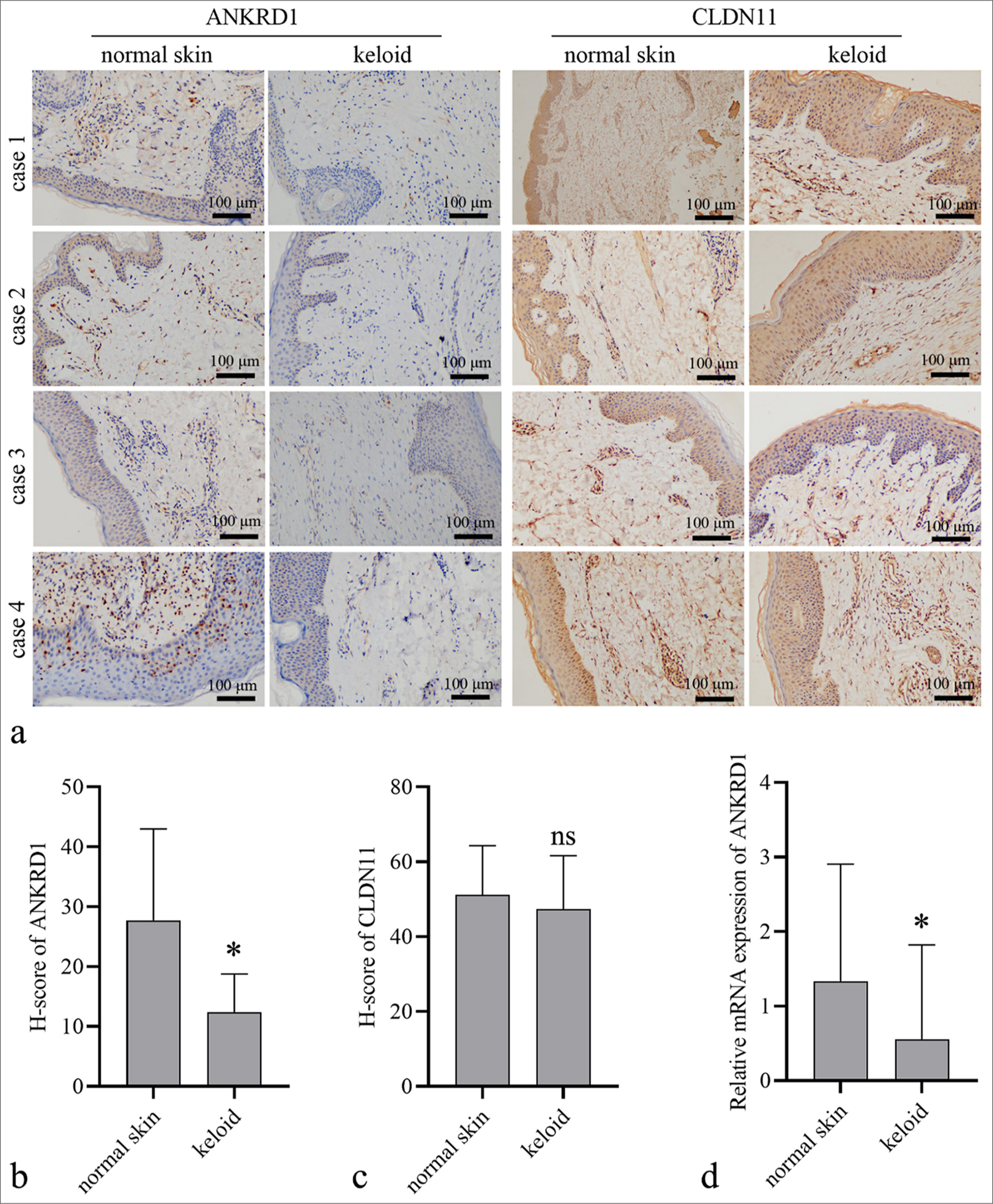 Ankyrin repeat domain 1 (ANKRD1) and claudin 11 (CLDN11) expression levels in keloid and normal skin tissues. (a) Representative images of IHC results (20×) results. (b and c) Quantitative analysis of the expression of ANKRD1 and CLDN11 in keloid tissues (n = 30) and normal skin tissues (n = 20). Protein expression was quantified based on the histochemistry score (H-score) measured using ImageJ software. (d) ANKRD1 messenger RNA (mRNA) expression levels in keloid tissues (n = 33) and normal skin tissues (n = 55). An unpaired t-test was used to analyze the statistical differences between the keloid and normal skin groups. ✶P < 0.05 when compared to normal skin ns, P > 0.05. IHC: Immunohistochemistry.