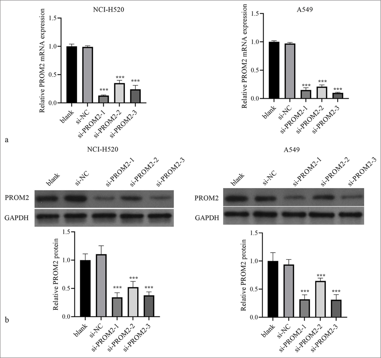 Silencing of PROM2 expression in NCI-H520 and A549. (a and b) The PROM2 protein and mRNA levels in the two types of NSCLC cells transfected with si-PROM2 or si-NC were measured by applying Western blot analysis with qRT-PCR. n = 3. Data are shown as means ± standard deviation. One-way ANOVA was utilized to analyze differences (✶✶✶P < 0.001, vs. si-NC). PROM2: Prominin 2, mRNA: Messenger ribonucleic acid, NSCLC: Non-small cell lung cancer, qRT-PCR: Quantitative real-time polymerase chain reaction, ANOVA: Analysis of variance, si-PROM2: siRNAs against PROM2; si-NC: siRNAs against negative control.