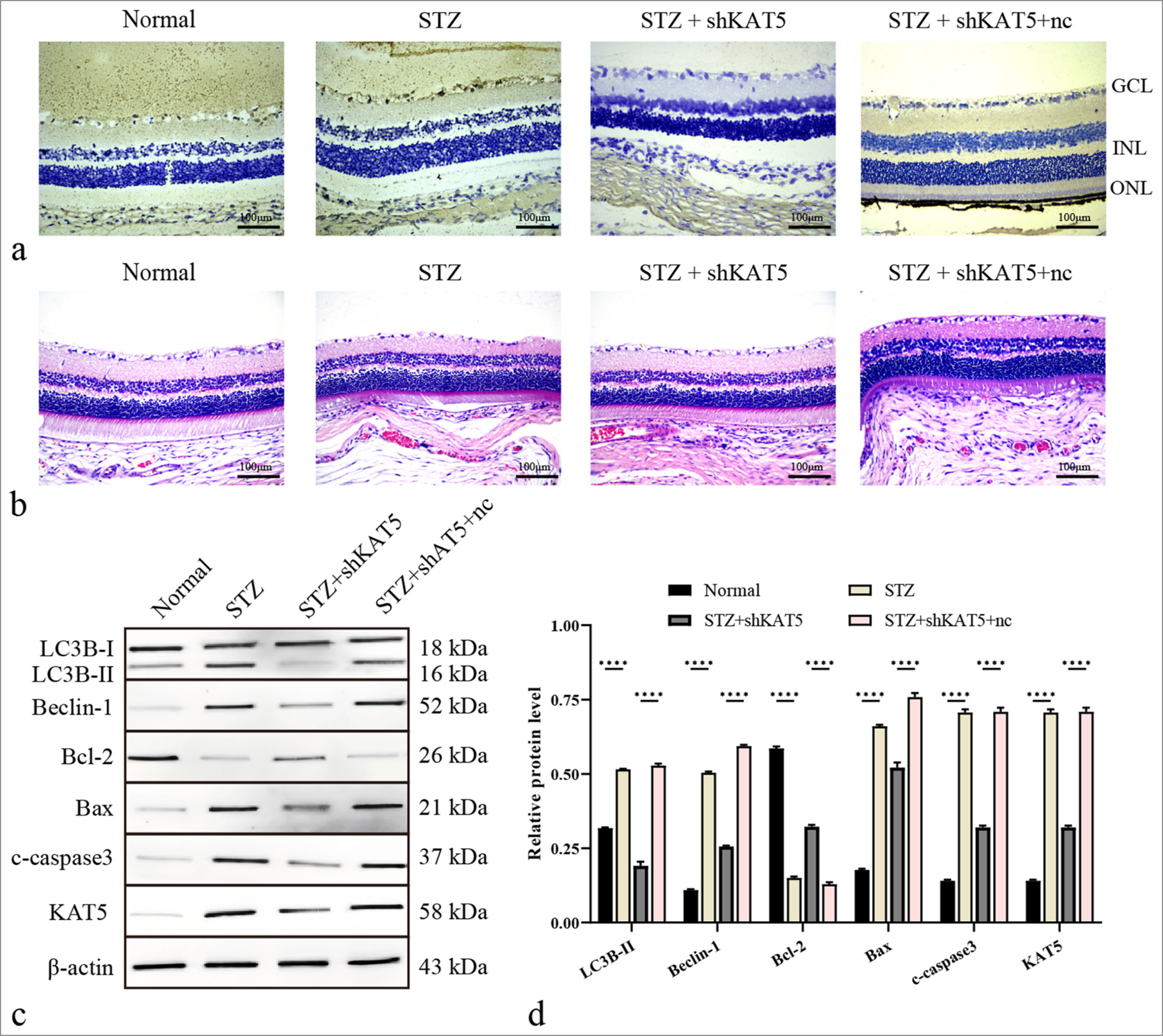 Depletion of KAT5 attenuates autophagy in diabetic retinopathy rat model. (a) KAT5 expression levels were assessed using IHC in rat retinal tissues. Scale bar = 100 μm. (b) Diabetic retinopathy injury was assessed using H&E staining. Scale bar = 100 μm. (c and d) The expression levels of proteins including KAT5, Bcl-2, Bax, c-caspase-3, Beclin-1, and LC3B-II in rat retinal tissues were assessed through Western blot analysis. ✶✶✶✶P < 0.0001. GCL: Ganglion cell layer, INL: Inner nuclear layer, ONL: Outer nuclear layer, KAT5: Lysine acetyltransferase 5, STZ: Streptozotocin, Bcl-2: B-cell lymphoma-2, Bax: BCL-2-associated X protein, LC3B: Microtubule-associated protein 1 light chain 3B, H&E: Hematoxylin and eosin.