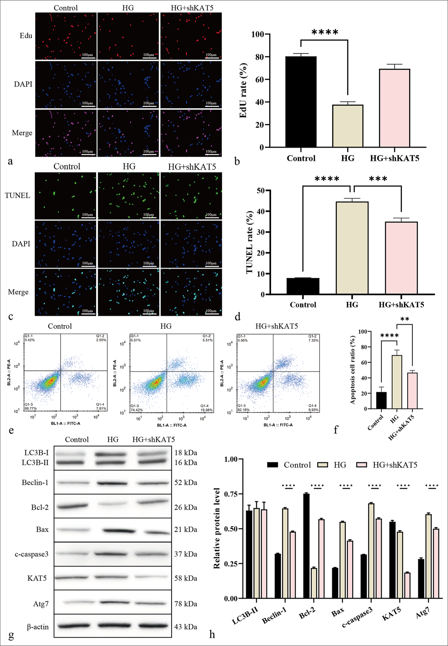 Knockdown of KAT5 represses autophagy in RF/6A cells exposed to HG condition. (a and b) Cell proliferation was measured by EdU assay. Scale bar = 100 μm. (c and d) Cell apoptosis was analyzed by TUNEL. Scale bar = 100 μm. (e and f) Cell apoptosis was assessed using flow cytometry. (g and h) The expression levels of proteins of Atg7, KAT5, Bcl-2, Bax, c-caspase-3, Beclin-1, and LC3B-II were assessed through Western blot analysis. ✶✶P < 0.01, ✶✶✶P < 0.001, and ✶✶✶✶P < 0.0001. HG: High glucose, Atg7: Autophagy-related protein 7, KAT5: lysine acetyltransferase 5, Bcl-2: B-cell lymphoma-2, Bax: BCL-2-associated X protein, c-caspase-3: cleaved caspase-3, LC3B: Microtubule-associated protein 1 light chain 3, EdU: 5-ethynyl-2’-deoxyuridine, TUNEL: Terminal deoxynucleotidyl transferase dUTP nick-end labeling.