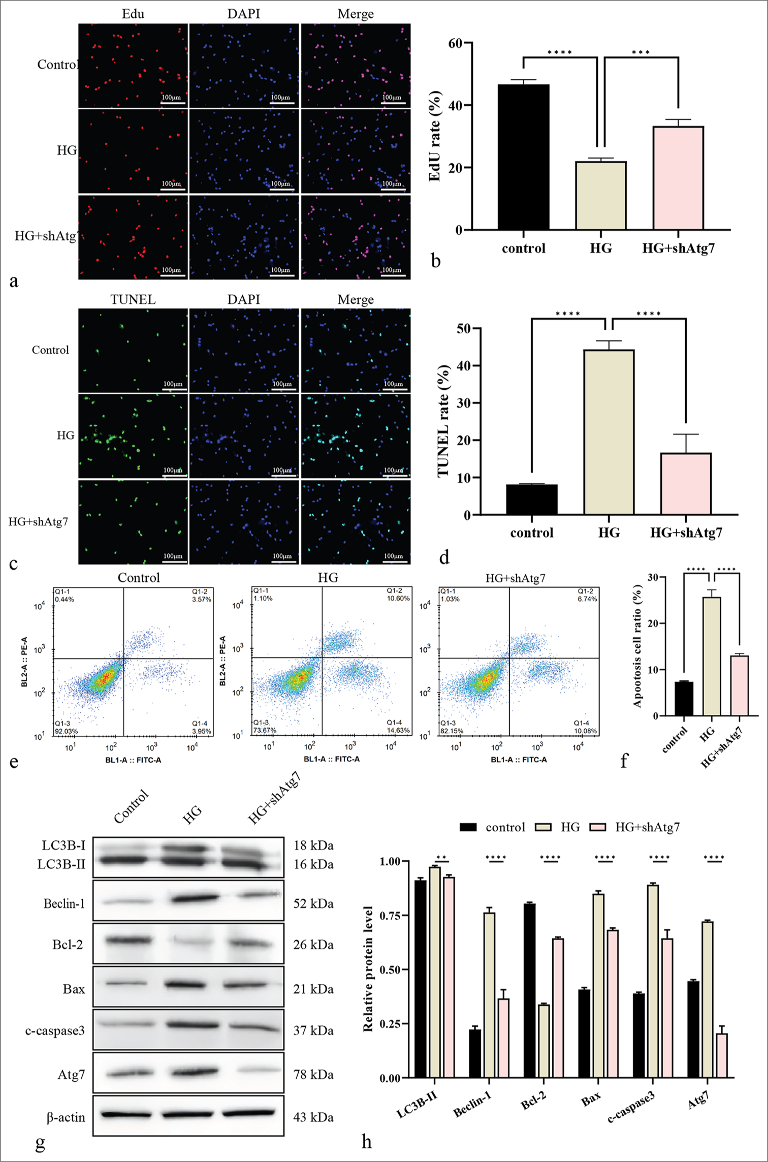 Knockdown of Atg7 suppresses autophagy in RF/6A cells under HG. (a and b) Cell proliferation was measured by EdU. Scale bar = 100 μm. (c and d) Cell apoptosis was analyzed by TUNEL. Scale bar = 100 μm. (e and f) Cell apoptosis was quantified by flow cytometry. (g and h) The protein levels of Atg7, Bcl-2, Bax, c-caspase-3, Beclin-1, and LC3B were using Western blot. ✶✶P < 0.01, ✶✶✶P < 0.001, ✶✶✶✶P < 0.0001. HG: High glucose, KAT5: Lysine acetyltransferase 5, Atg7: Autophagy-related protein 7, Bcl-2: B-cell lymphoma-2, Bax: BCL-2-associated X protein, c-caspase-3: Cleaved caspase-3, LC3B: Microtubule-associated protein 1 light chain 3B, EdU: 5-ethynyl-2’-deoxyuridine, TUNEL: Terminal deoxynucleotidyl transferase dUTP nick-end labeling.