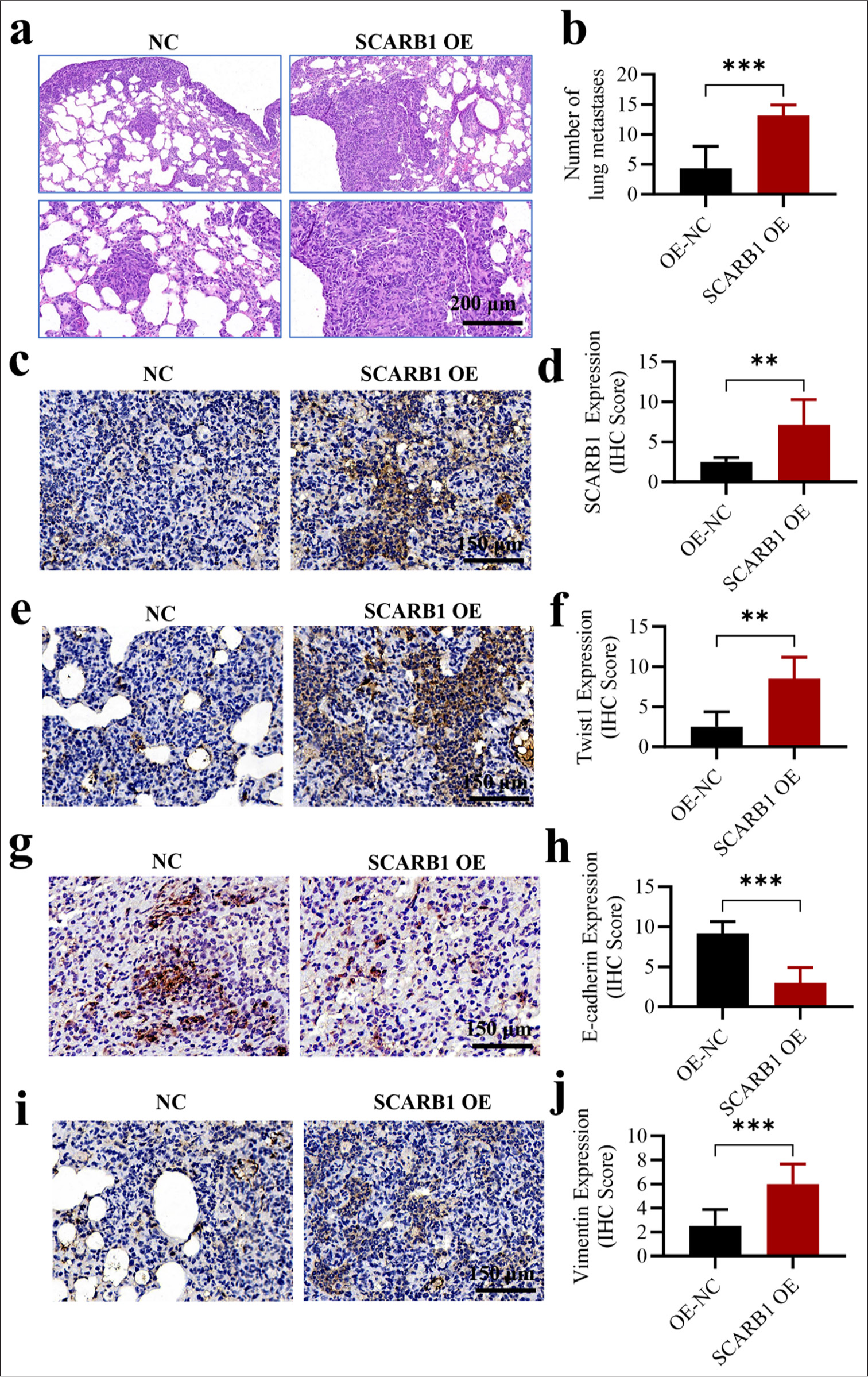 SCARB1 overexpression promotes lung cancer EMT and metastasis through Twist1 activation in vivo. (a and b) H&E staining, objective: 100×, showed that SCARB1 overexpression enhanced the formation of metastatic nodules in the lung metastasis model after tail vein injection. (c and d) Immunohistochemical staining, Objective: 200×, of SCARB1 in metastatic tumor tissues. (e and f) Immunohistochemical staining, Objective: 200×, of Twist1 in metastatic tumor tissues. (g and h) Immunohistochemical staining, objective: 200×, of E-cadherin in metastatic tumor tissues. (i and j) Immunohistochemical staining, objective: 200×, of vimentin in metastatic tumor tissues. n = 6. ✶✶P < 0.01, ✶✶✶P < 0.001. EMT: Epithelial–mesenchymal transition, H&E: Hematoxylin and Eosin, Twist1: Twist family bHLH transcription factor 1, SCARB1: Scavenger receptor class B member 1; H&E, hematoxylin & eosin.