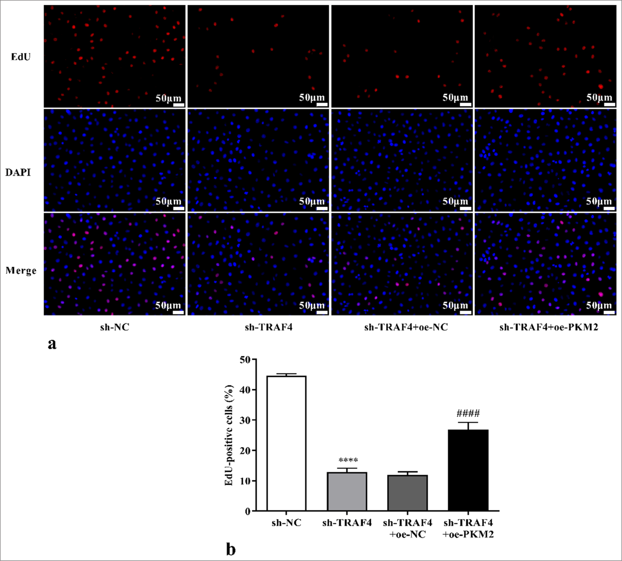 Effects of sh-TRAF4 and oe-PKM2 co-transfection on CRC cell proliferation were detected with the EdU assay, 200×, (a) EdU images [scale bar: 50 μm], (b) statistical analysis. (n = 3). ✶✶✶✶P < 0.0001, versus sh-NC group. ####P < 0.0001, versus sh-TRAF4 + oe-NC group. PKM2: Pyruvate kinase muscle isoform 2, CRC: Colorectal cancer, TRAF4: Tumor necrosis factor receptor-associated factor 4, oe: Overexpression, EdU: 5-ethynyl-2’-deoxyuridine, DAPI: 4’-6-diamidino-2-phenylindole, NC: Negative control, sh: Short hairpin.