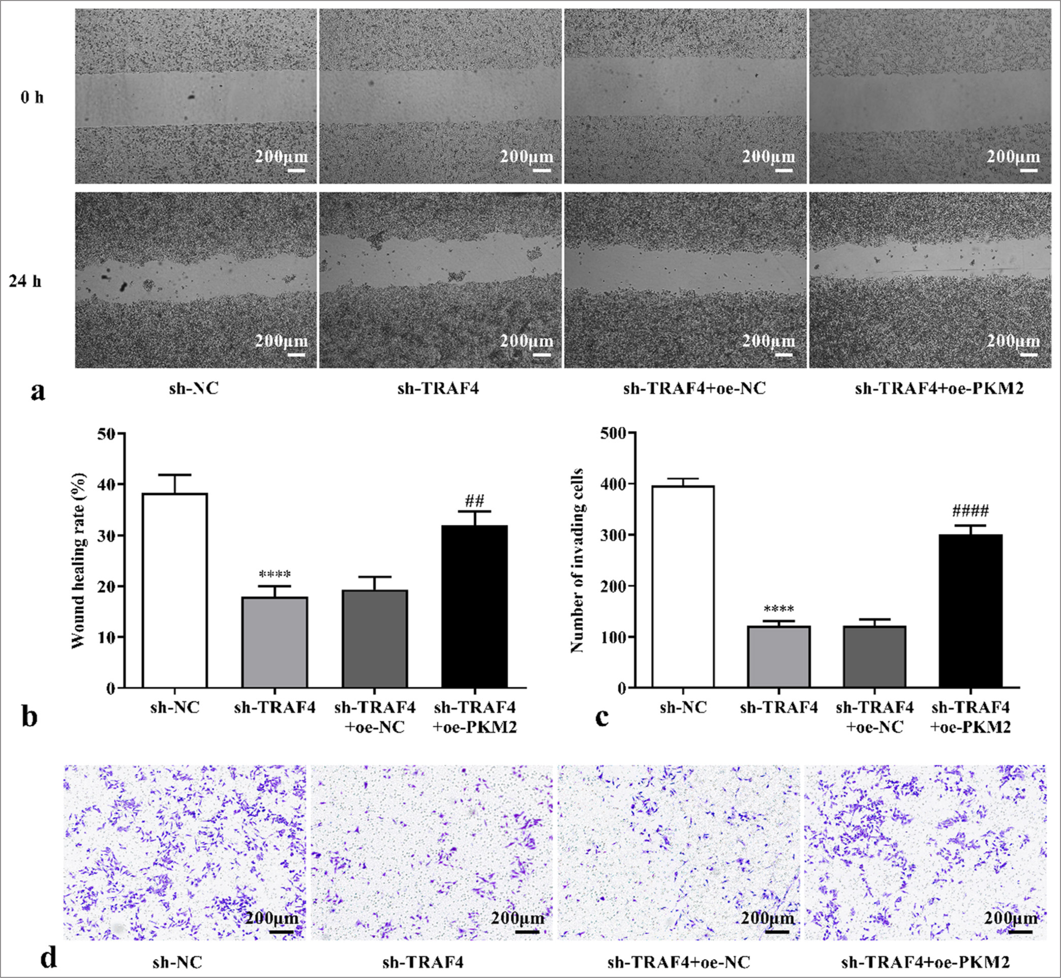 Changes in migration and invasion in the Lovo cells were detected after oe-PKM2 and sh-TRAF4 co-transfection (a) Cell scratch images, 40×, [scale bar: 200 μm], (b and c) statistical analysis of wound healing rate and number of invading cells, (d) Transwell invasion images, 40×, [scale bar: 200 μm]. (n = 3). ✶✶✶✶P < 0.0001, versus sh-NC group. ##P < 0.01, ####P < 0.0001, versus sh-TRAF4 + oe-NC group. PKM2: Pyruvate kinase muscle isoform 2, TRAF4: Tumor necrosis factor receptor-associated factor 4, oe: Overexpression, NC: Negative control, sh: Short hairpin.