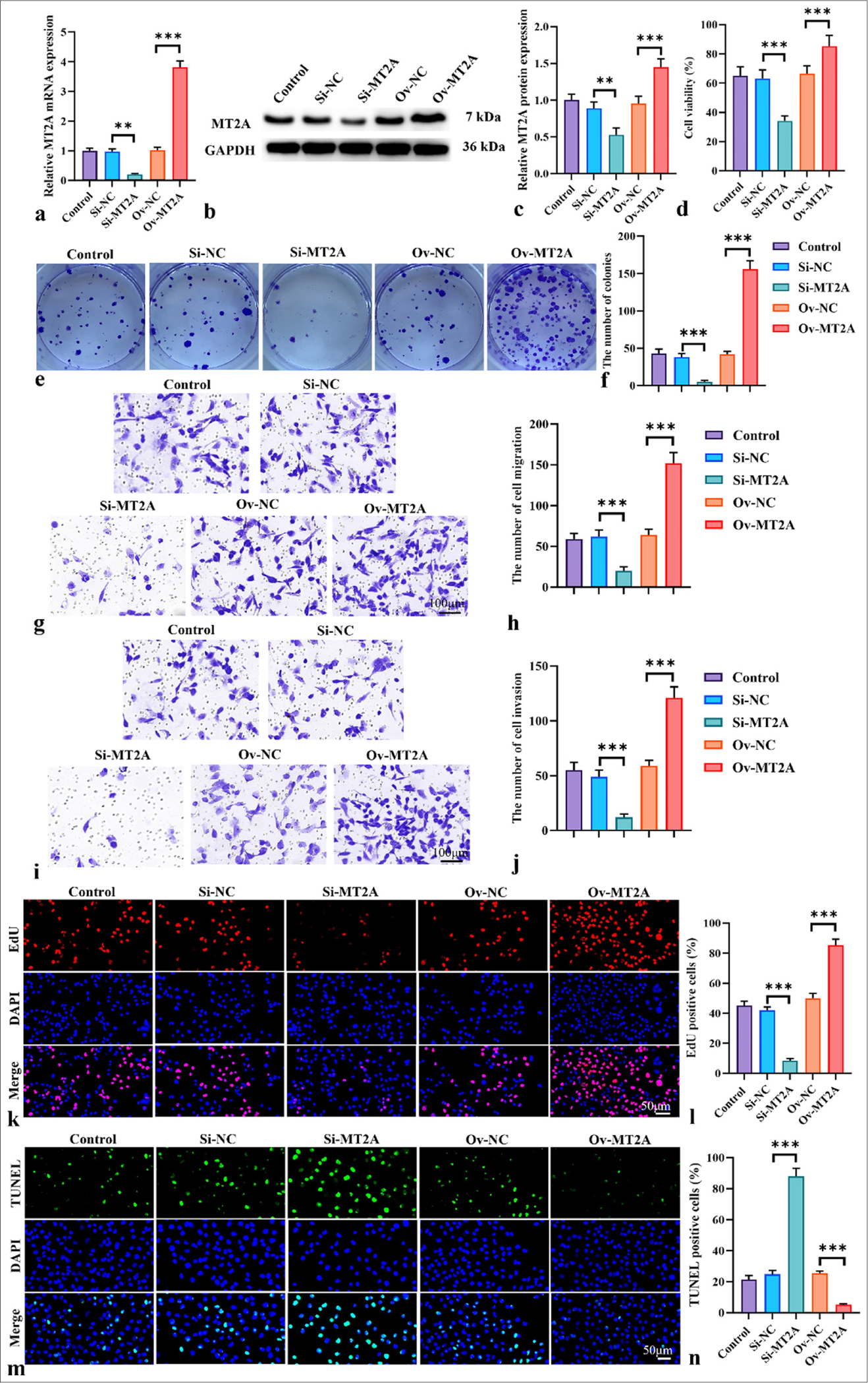 MT2A enhances the invasion and migration of SCLC cells. (a-c) qRT-PCR and Western blot analysis, Objective: 200x, were used to analyze the efficiency of MT2A expression following the transfection of siRNA MT2A or pCMV-MT2A into NCI-H69 cells. (d) Proliferation of NCI-H69 cells after MT2A knockdown and overexpression was assessed by using the CCK-8 assay, Objective: 200x. (e and f) Proliferation of NCI-H69 cells after MT2A knockdown and overexpression was evaluated through the colony formation assay. (g-j) Transwell assay, Objective: 200x, was conducted to determine the migration (g and h) and invasion (i and j) of NCI-H69 cells after MT2A knockdown and overexpression. (k and l) Proliferation rate of NCI-H69 cells was determined through EdU staining, Objective: 200x. (m and n) Apoptosis rate of NCI-H69 cells was determined through TUNEL staining, Objective: 200x. n = 3, ✶✶P < 0.01, ✶✶✶P < 0.001. MT2A: Metallothionein 2A, SCLC: Small-cell lung cancer, CCK-8: Cell counting kit-8, EdU: 5-ethynyl-2'-deoxyuridine, TUNEL: Terminal deoxynucleotidyl transferase-mediated dUTP nick end labeling, qRTPCR: Quantitative reverse transcription polymerase chain reaction.