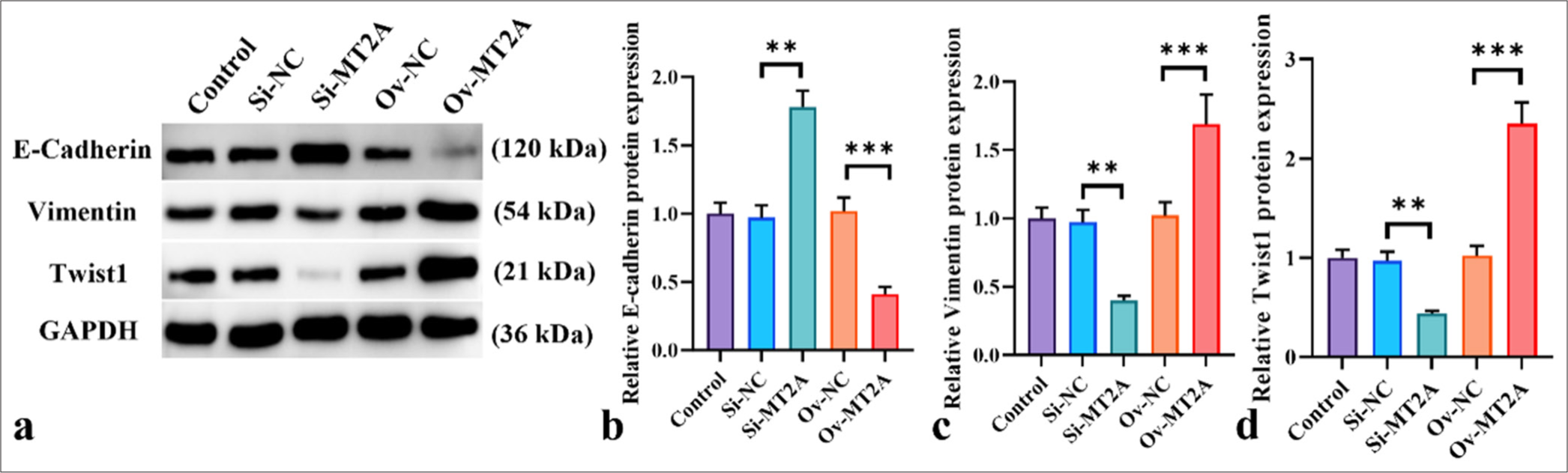 MT2A facilitates EMT in SCLC cells. (a-d) Western blot analysis of E-cadherin, vimentin, and Twist1 following MT2A knockdown or overexpression. n = 3, ✶✶P < 0.01, ✶✶✶P < 0.001. MT2A: Metallothionein 2A, SCLC: Small-cell lung cancer.