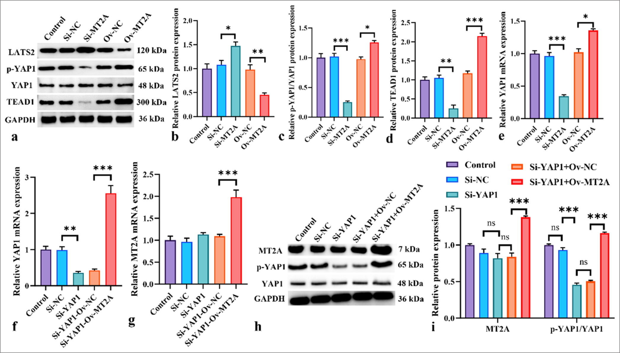 Inhibition of YAP1 signaling activation by MT2A knockdown. (a-d) Western blot analysis was conducted to show the effects of MT2A overexpression or knockdown on TEAD, p-YAP1/YAP1, LAST2, and TEAD protein expression levels in NCI-H69 cells. (e) Effects of MT2A overexpression or knockdown on YAP1 mRNA levels. (f) YAP1 mRNA expression levels in NCI-H69 cells following YAP1 knockdown or cotransfection with the MT2A overexpression plasmid. (g) MT2A mRNA expression levels in NCI-H69 cells following YAP1 knockdown or cotransfection with the MT2A overexpression plasmid. (h and i) Expression levels of MT2A and p-YAP1/YAP1 after YAP1 silencing and MT2A overexpression. n = 3, ns: No significant difference, ✶P < 0.05, ✶✶P < 0.01, ✶✶✶P < 0.001. YAP1: Yes-associated protein 1, MT2A: Metallothionein 2A, LATS2: Large tumor suppressor 2, TEAD1: TEA domain transcription factor 1.