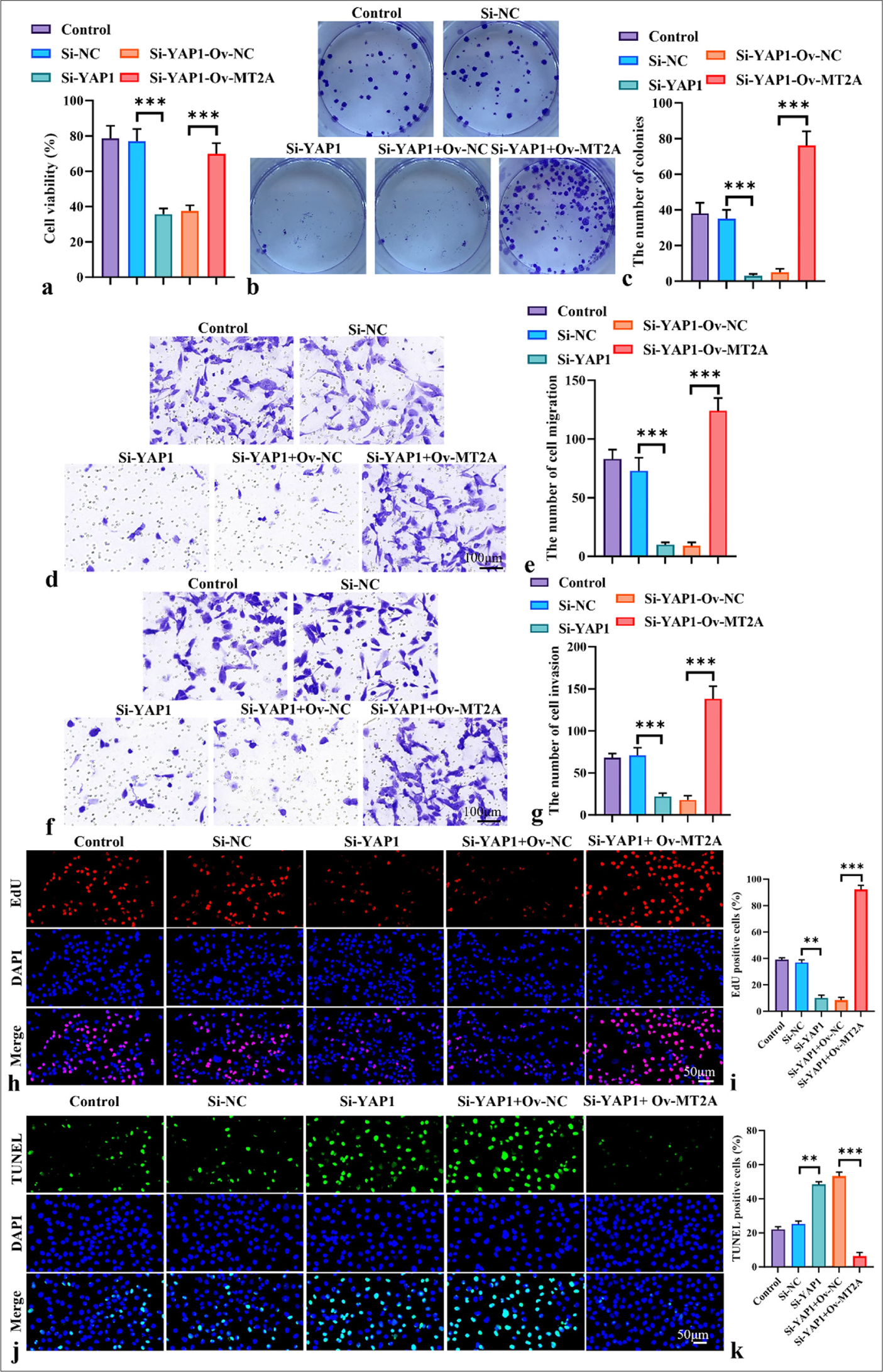 MT2A promotes the proliferation and metastasis of SCLC cells by regulating YAP1 expression. (a) CCK-8 assay of the viability of NCI-H69 cells following YAP1 knockdown or cotransfection with the MT2A overexpression plasmid, Objective: 200x,. (b and c) Colony formation assay of the proliferation ability of NCI-H69 cells following YAP1 knockdown or cotransfection with the MT2A overexpression plasmid. (d-g) Transwell assay, Objective: 200x, analysis of the migration and invasion of NCI-H69 cells following YAP1 knockdown or cotransfection with the MT2A overexpression plasmid. (h and i) EdU staining, Objective: 200x, of NCI-H69 cells after YAP1 silencing and MT2A overexpression. (j and k) TUNEL staining, Objective: 200x, of NCI-H69 cells after YAP1 silencing and MT2A overexpression. n = 3, ✶✶P < 0.01, ✶✶✶P < 0.001. MT2A: Metallothionein 2A, SCLC: Small-cell lung cancer, YAP1: Yes-associated protein 1, CCK-8: Cell counting kit-8, EdU: 5-ethynyl-2'-deoxyuridine, TUNEL: Terminal deoxynucleotidyl transferase-mediated dUTP nick end labeling.